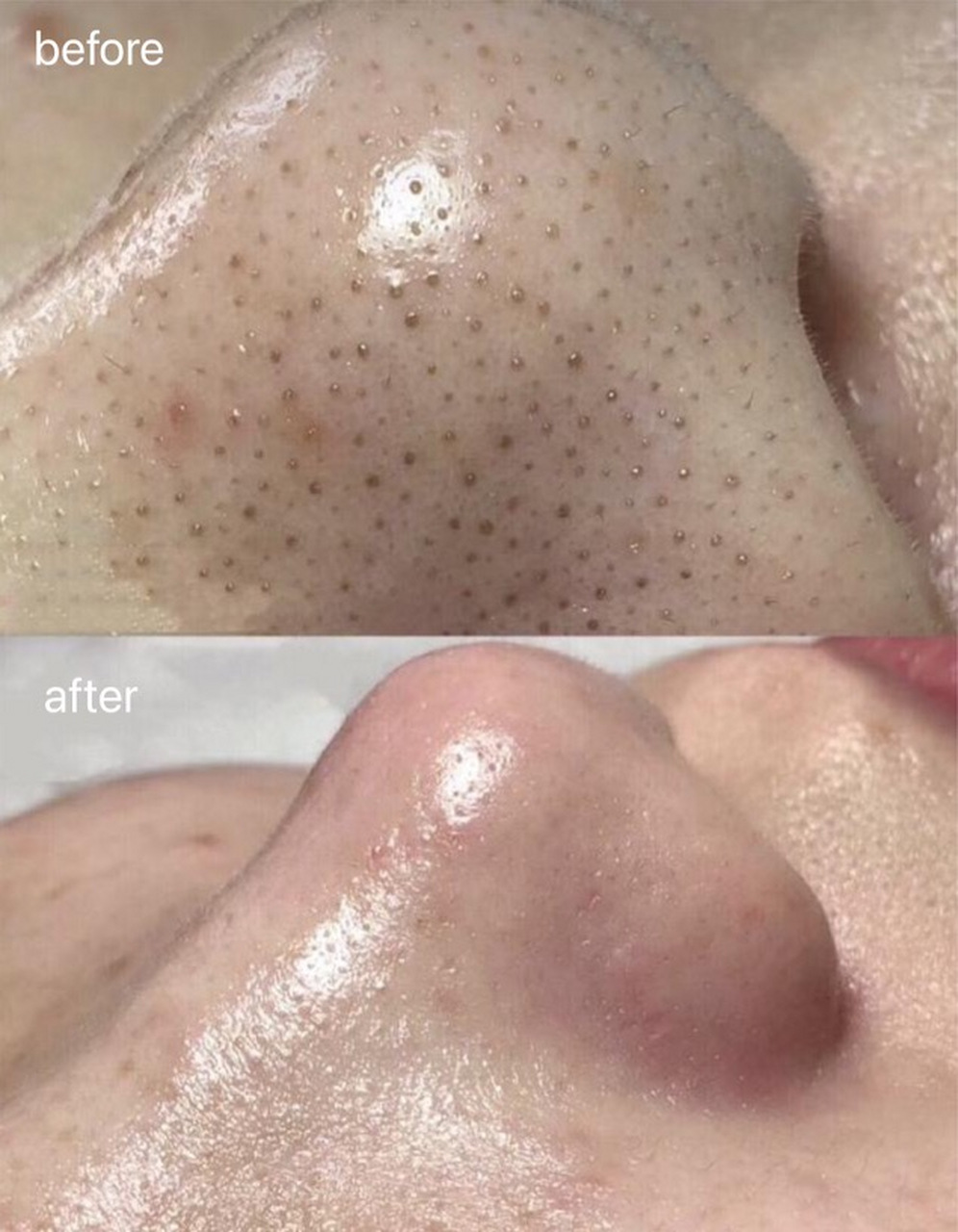 去黑头毛孔粗大最有效的方法  去除黑头和减少毛孔粗大的最有效方法之