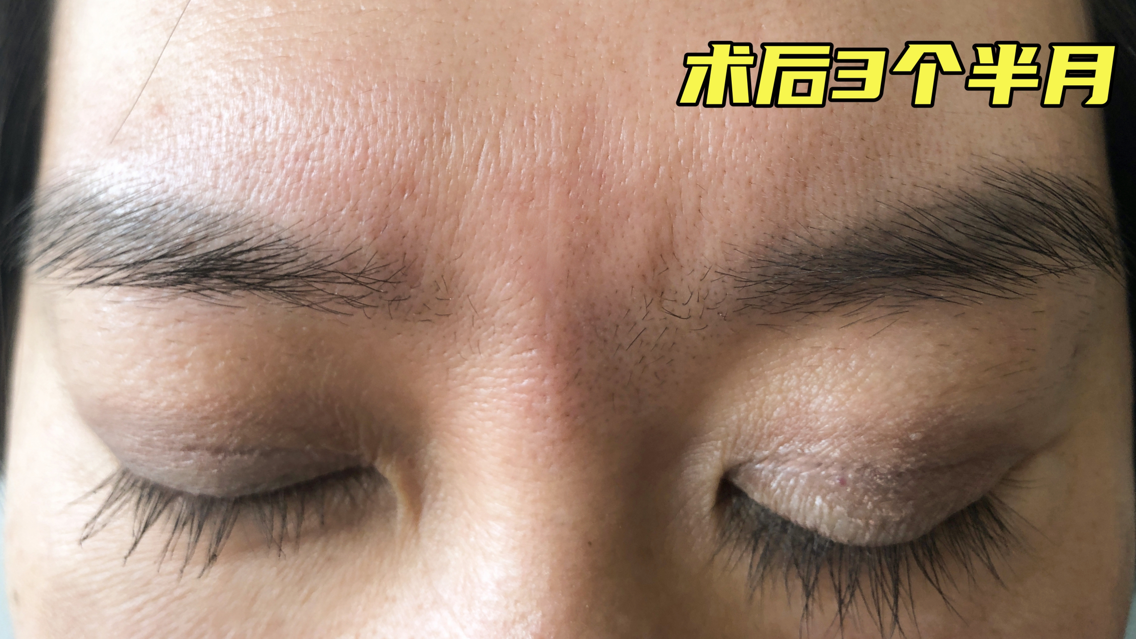 为什么我"敢 "做#川字纹# 切除手术?