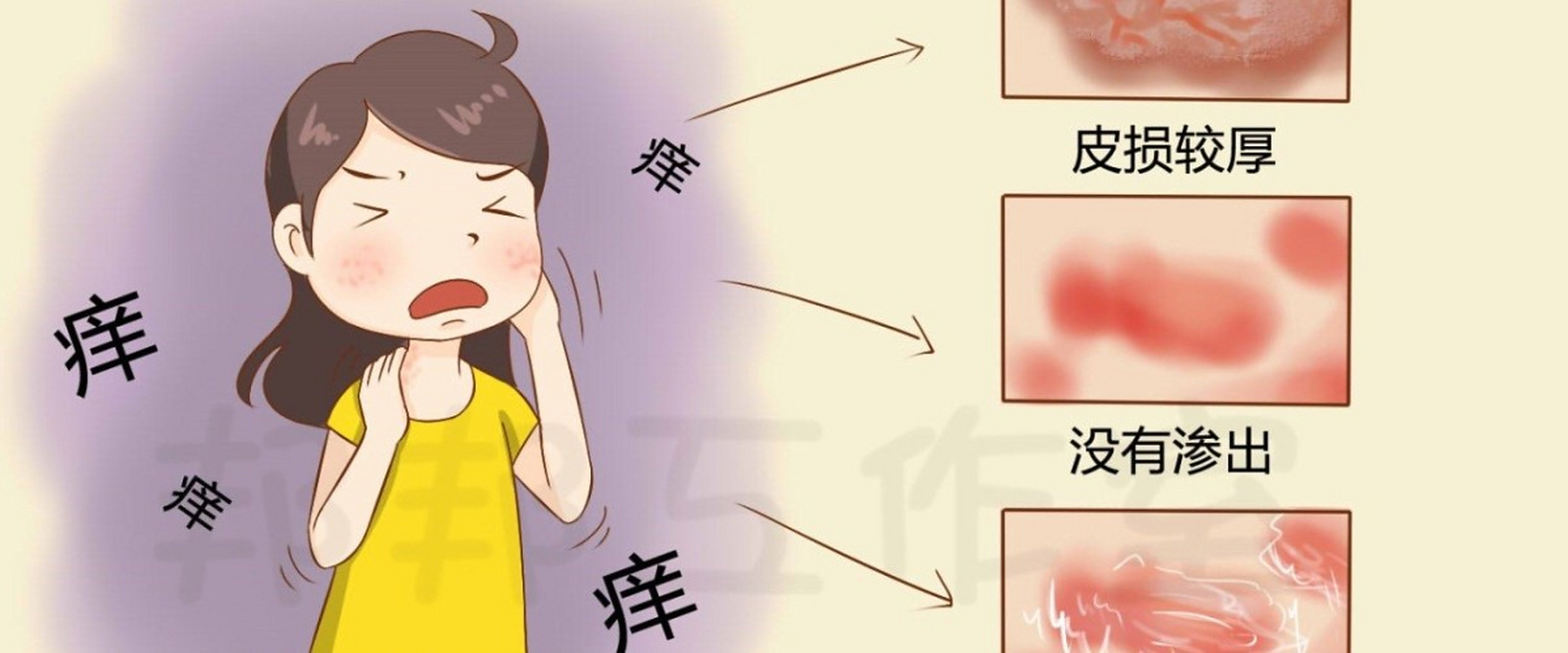 湿疹实际上它的概念比较广泛,很多以前诊断湿疹的病,如果再仔细分析