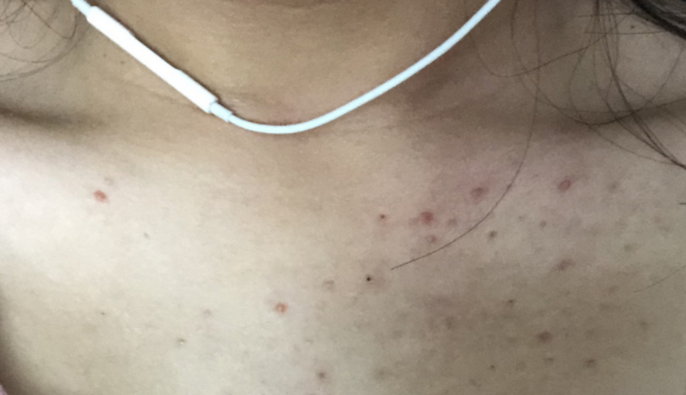 小王,最近前胸后背长了很多红痘痘    于是前去药店买了红霉素软  