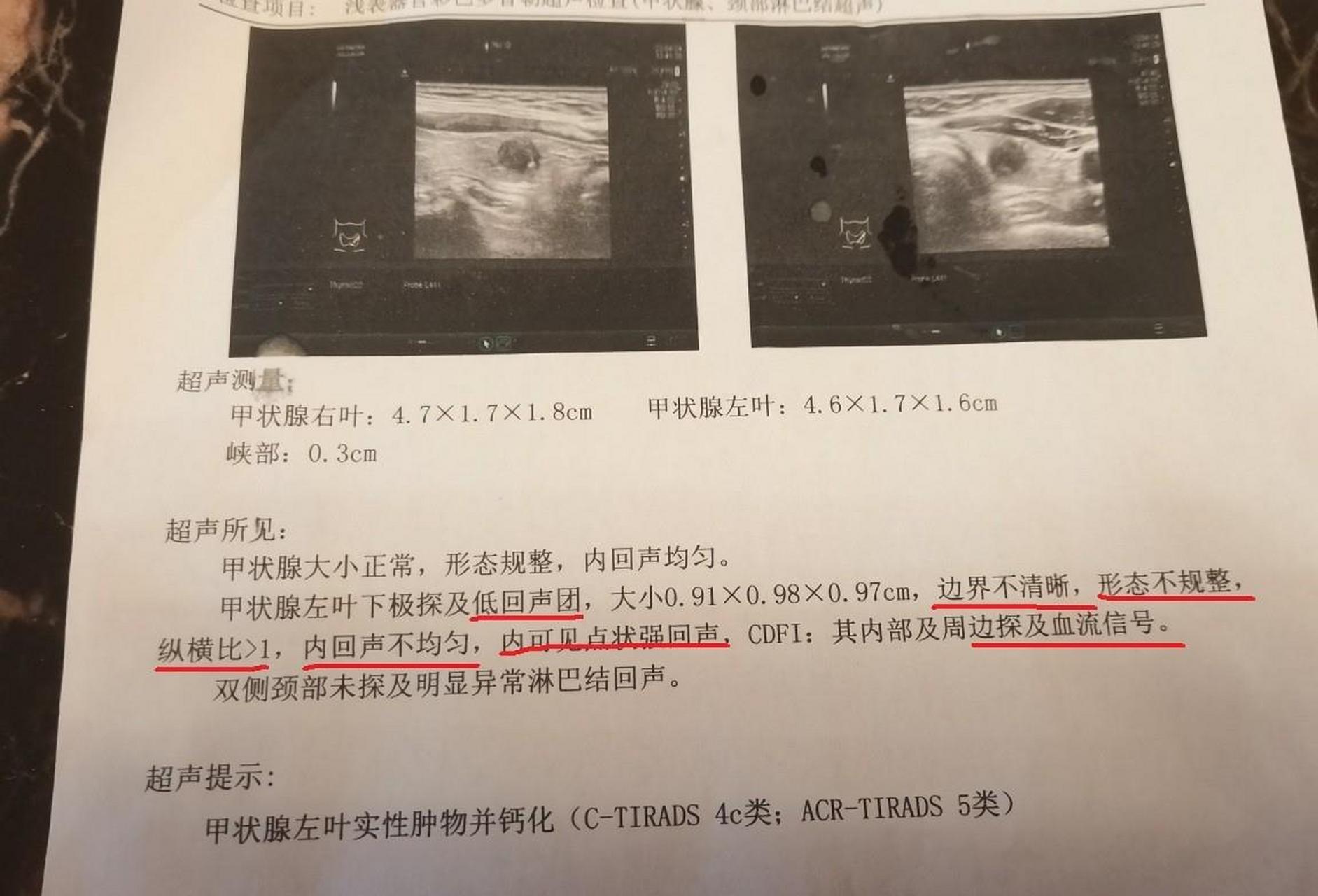 甲状腺超声报告的"潜台词" 1,无回声:常提示囊肿; 2,低回声:常提示实
