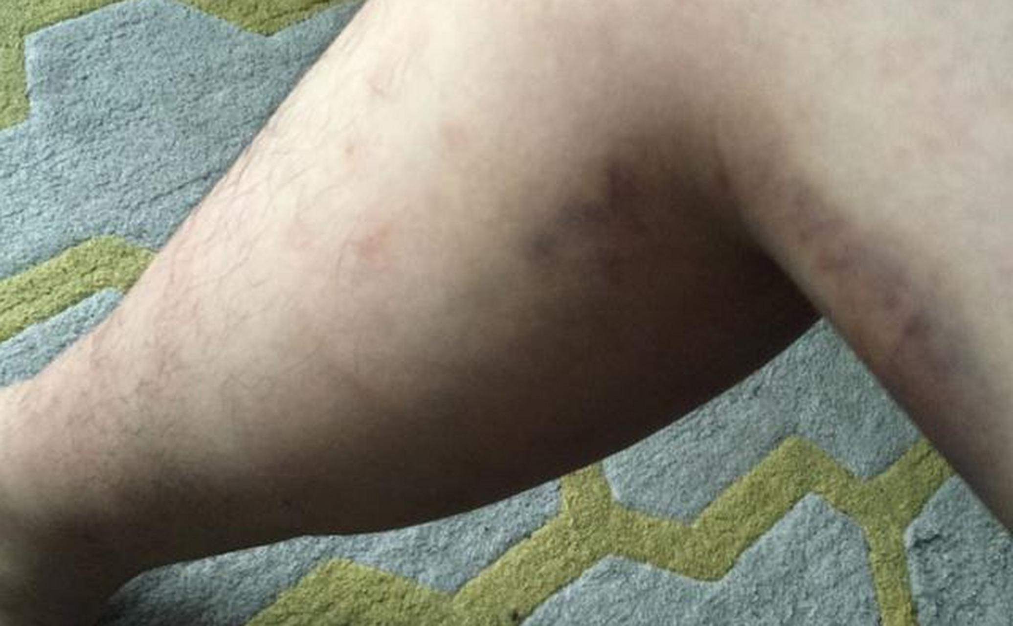 罗先生近期发现腿上长了好多瘀斑,自己也没有磕碰,观察了几天不但没