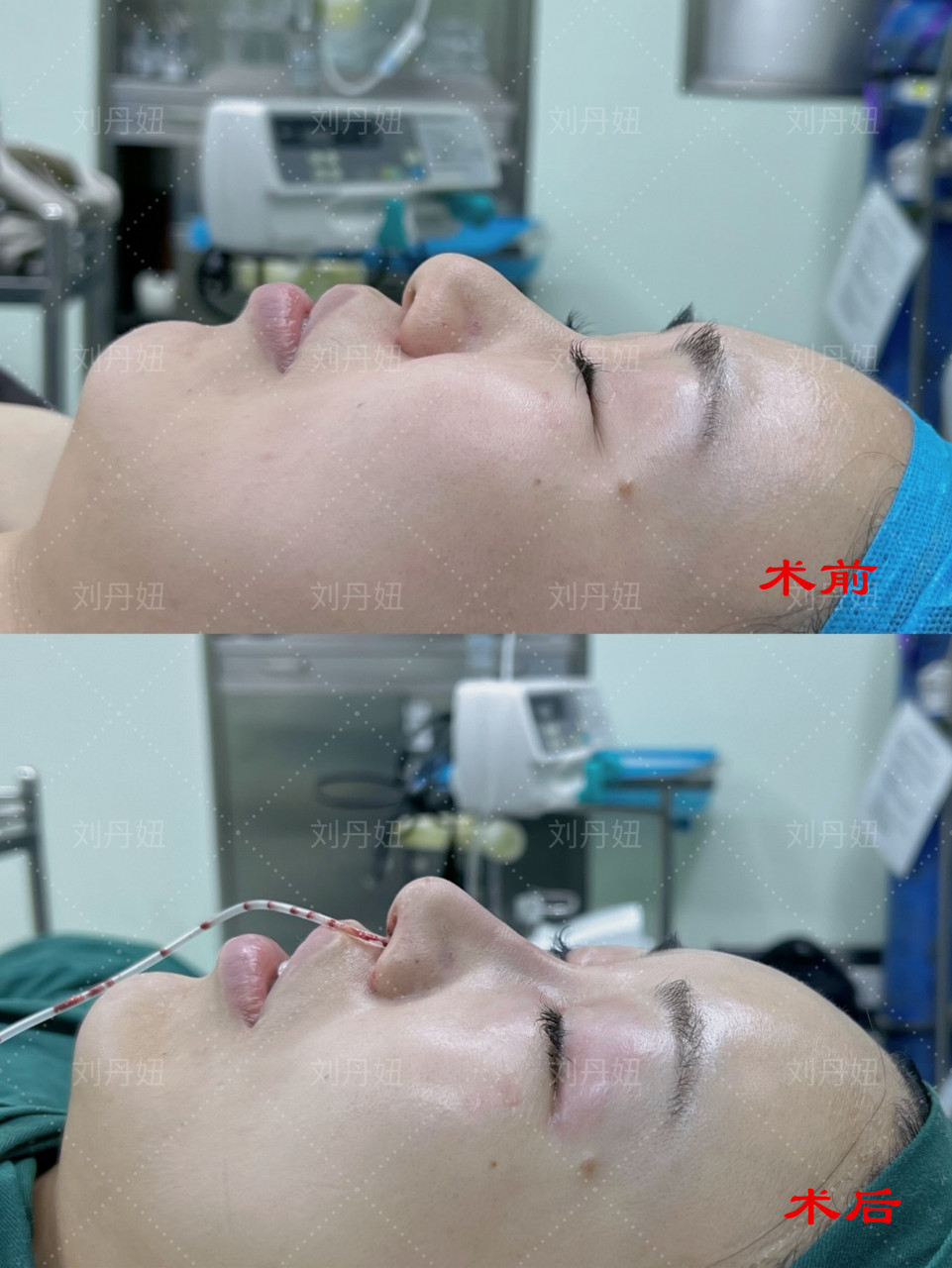 25岁的小姑娘鼻小柱发育短小,鼻基底凹陷,加上双侧鼻孔不对称,ct片子