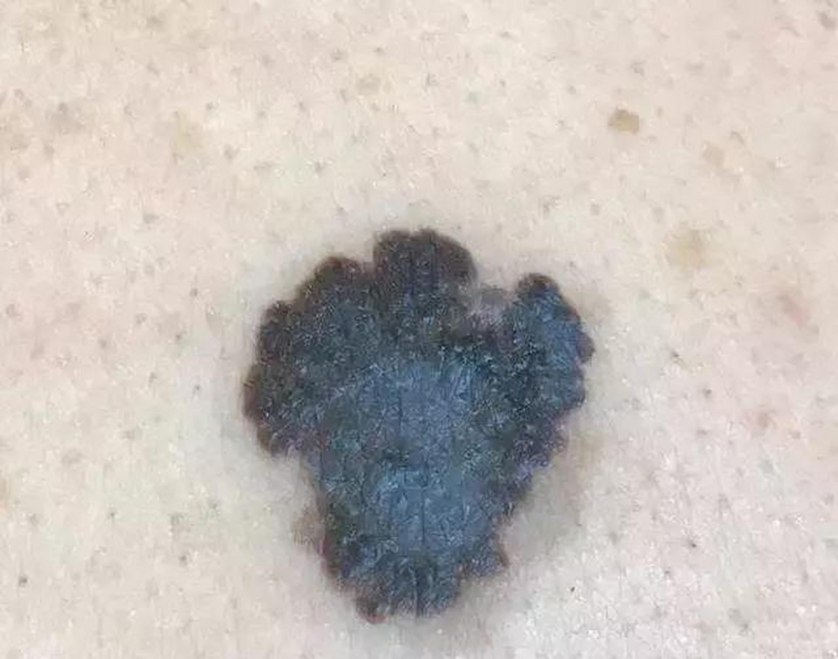 黄女士52岁,前一段时间额头上长了一颗褐色的痣,不痛不痒,不影响生活