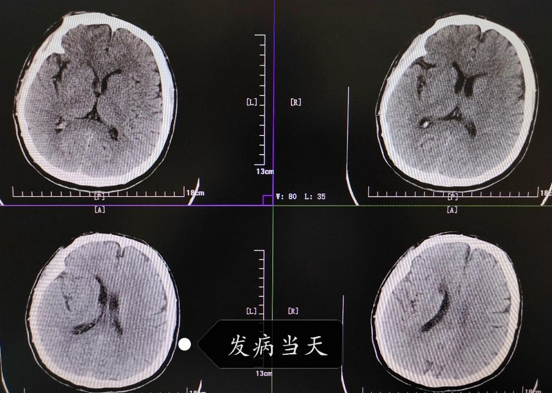 大脑会出现半身不遂,语言障碍,口眼歪斜等症状,这就是脑梗后遗症,也就