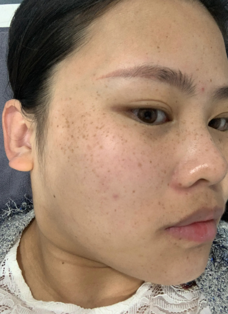 脸上有黄褐斑怎么排毒最有效呢?