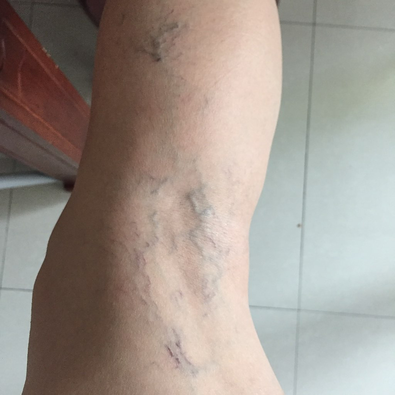 静脉曲张会有什么危害 第一静脉曲张会引起下肢静脉隆起,形成像蚯蚓一