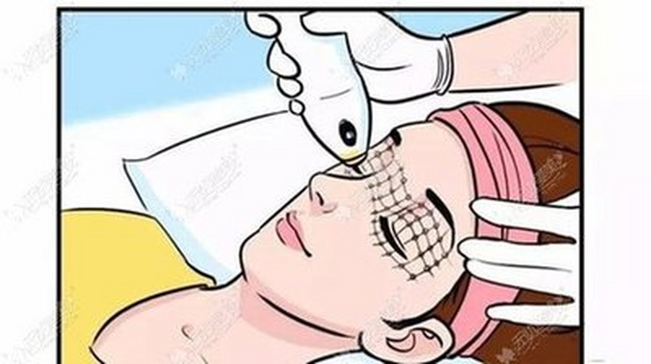 眼周射频能够有效改善眼部长皱纹或者松弛下垂的症状,主要是通过