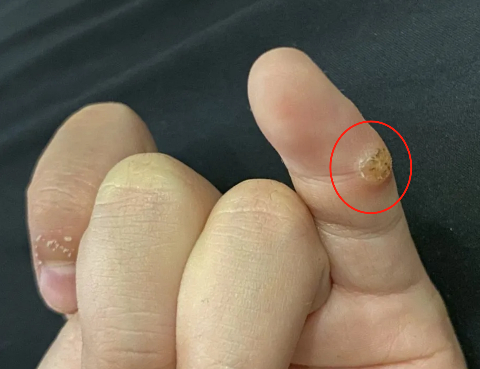最近门诊遇到的这个小患者,手指上就长了个寻常疣,也叫"瘊子或是刺瘊"