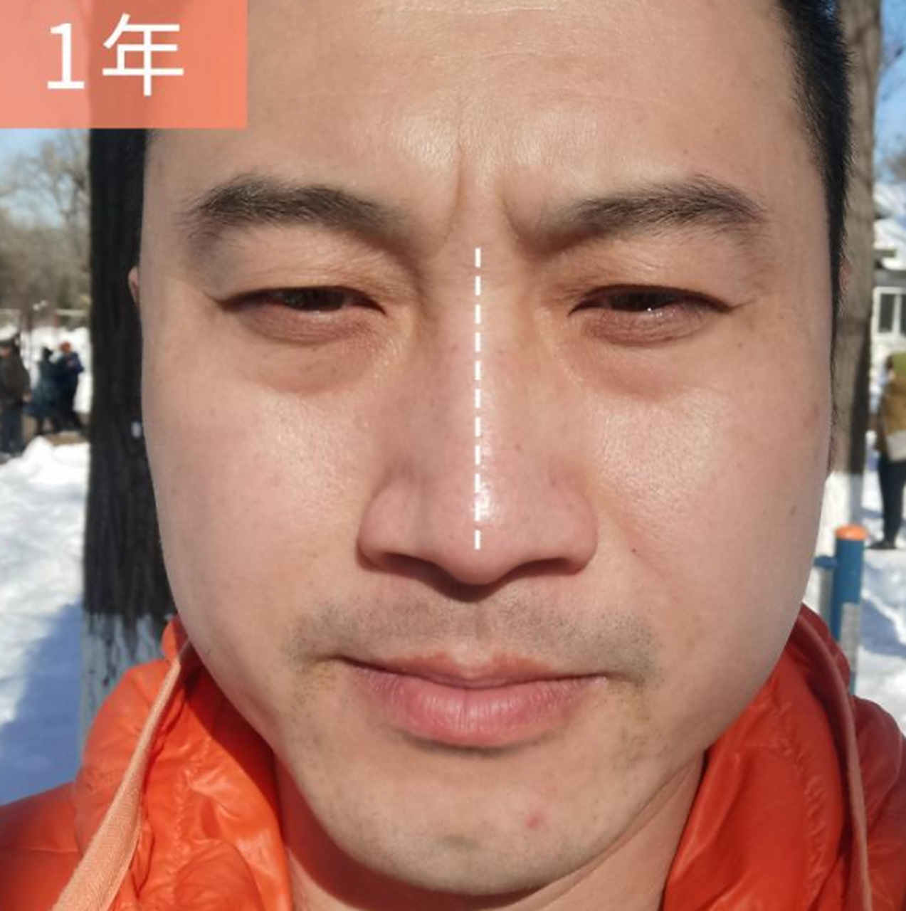 下面这位男患者,35岁,先天性歪鼻,术后做了鼻子矫正,通气都顺了呢