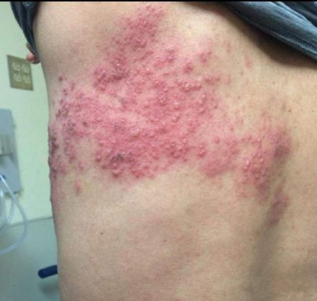 带状疱疹俗称"缠腰火丹""串腰龙""缠腰龙",是水痘-带状疱疹病毒藻体