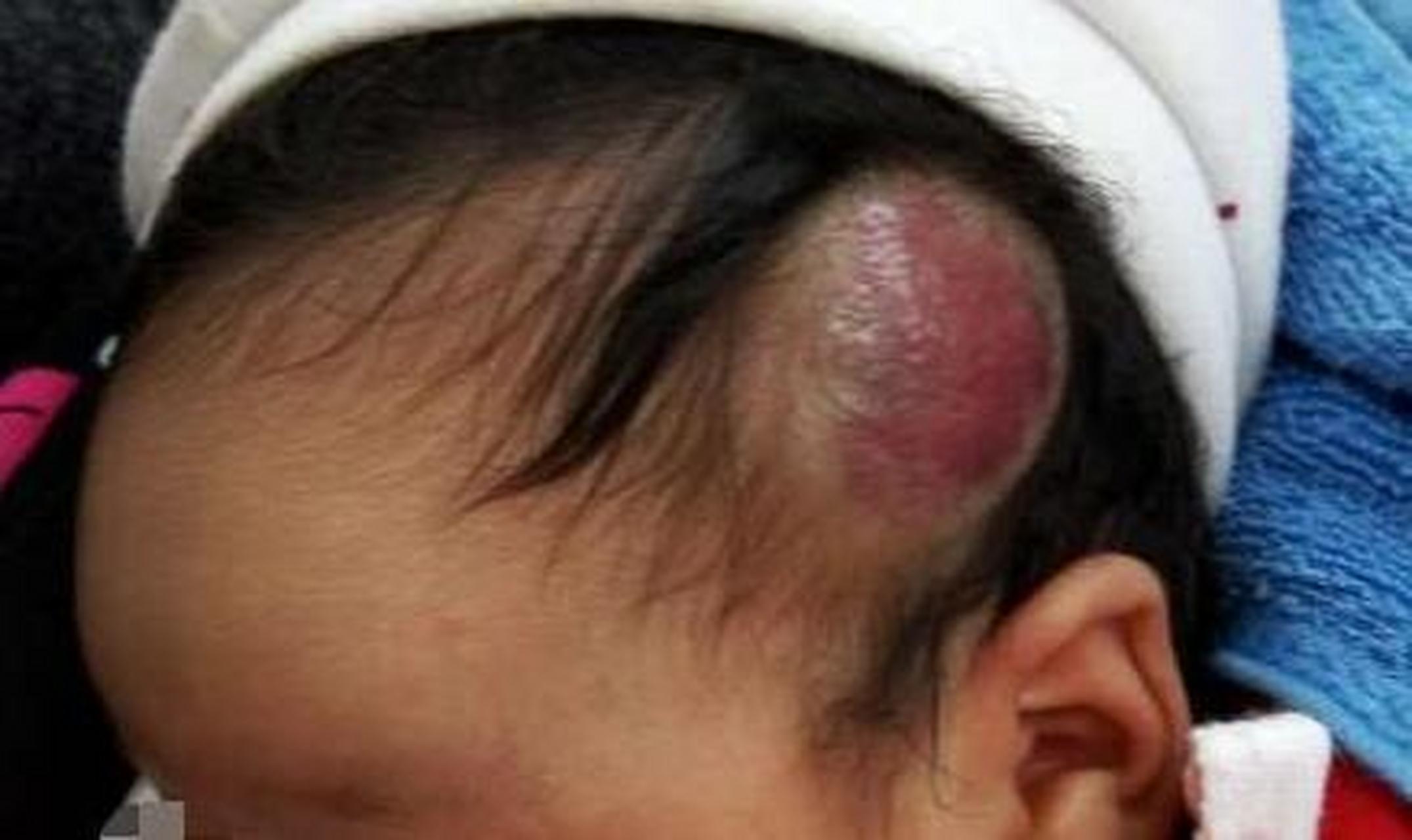 婴幼儿血管瘤# #健康科普