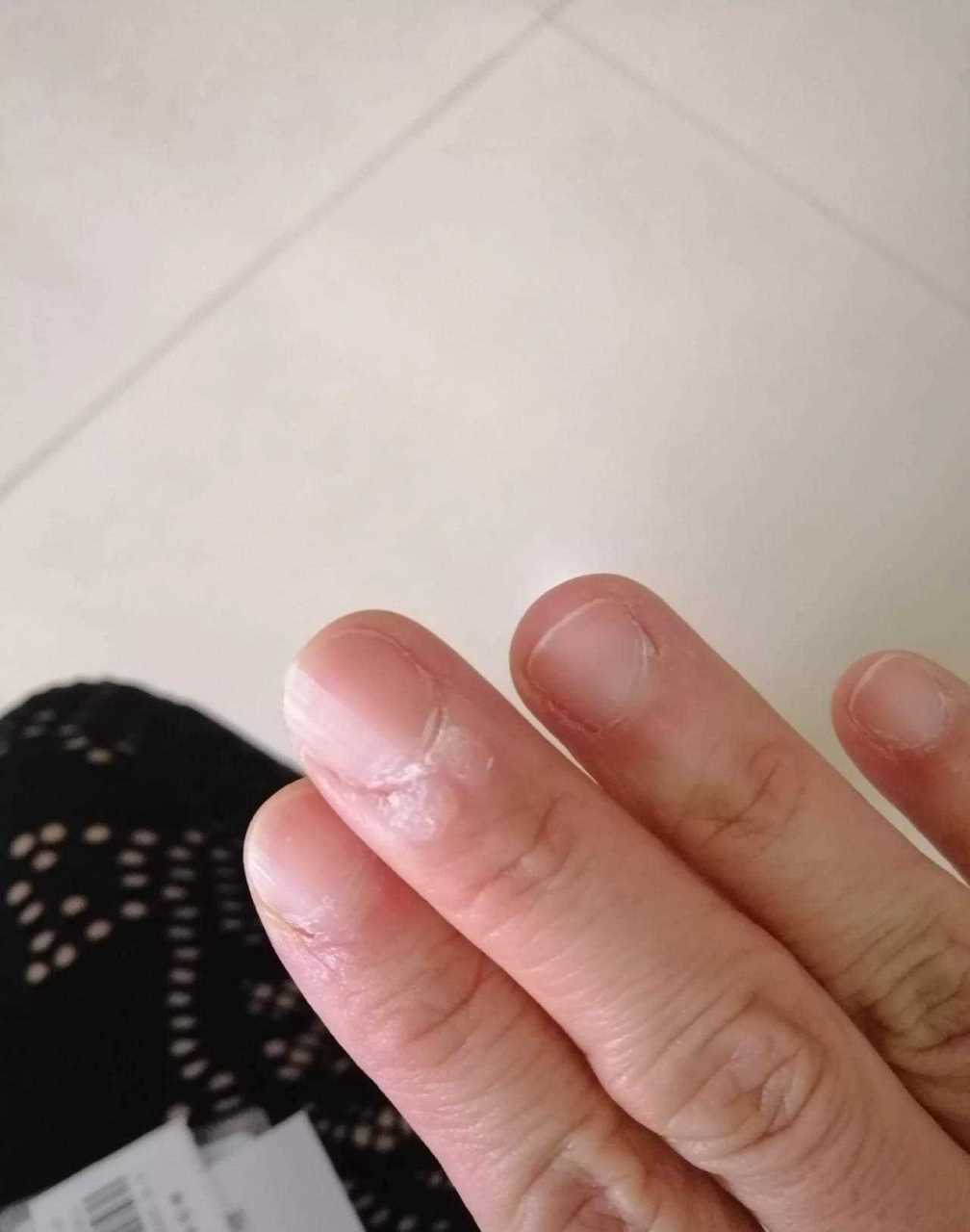 昨天特地去医院处理了一下我手指上的两个疣.
