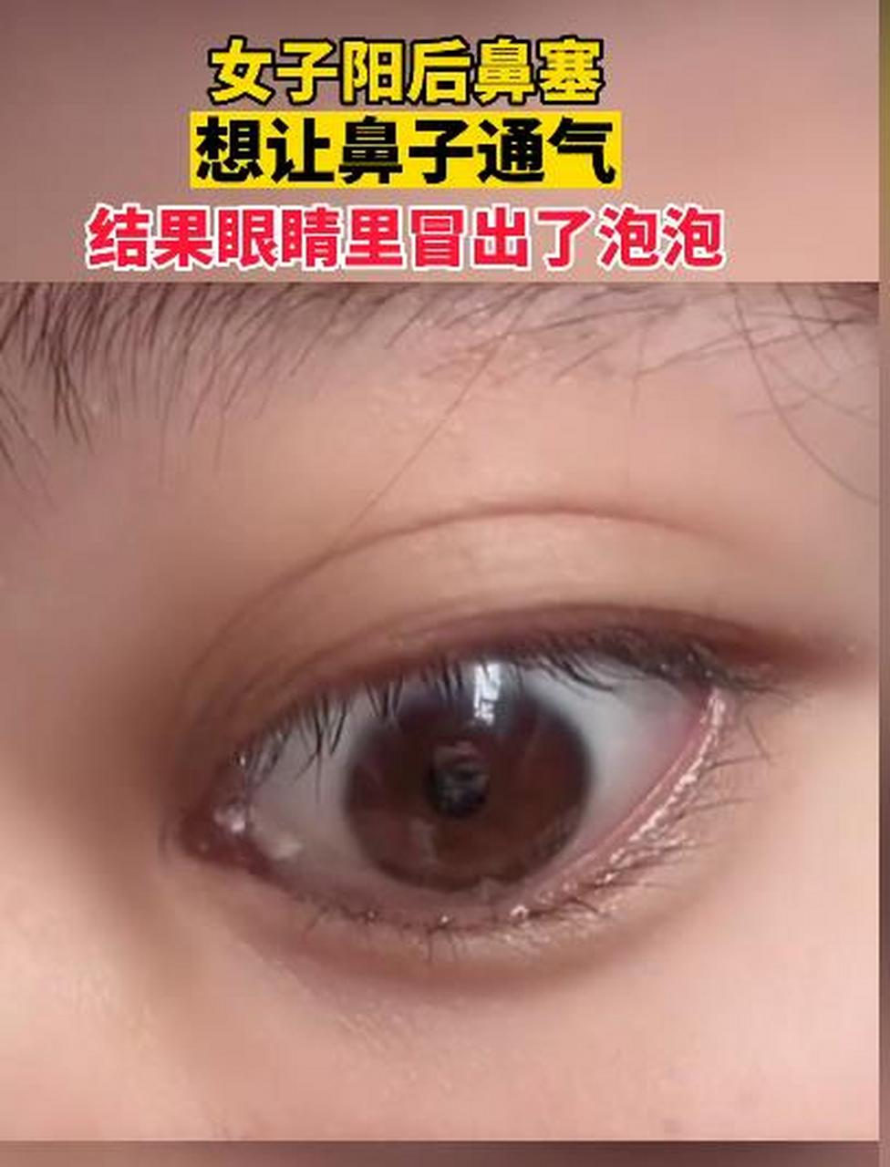 女子阳后鼻塞,想通气,结果眼睛里冒出来泡泡了!