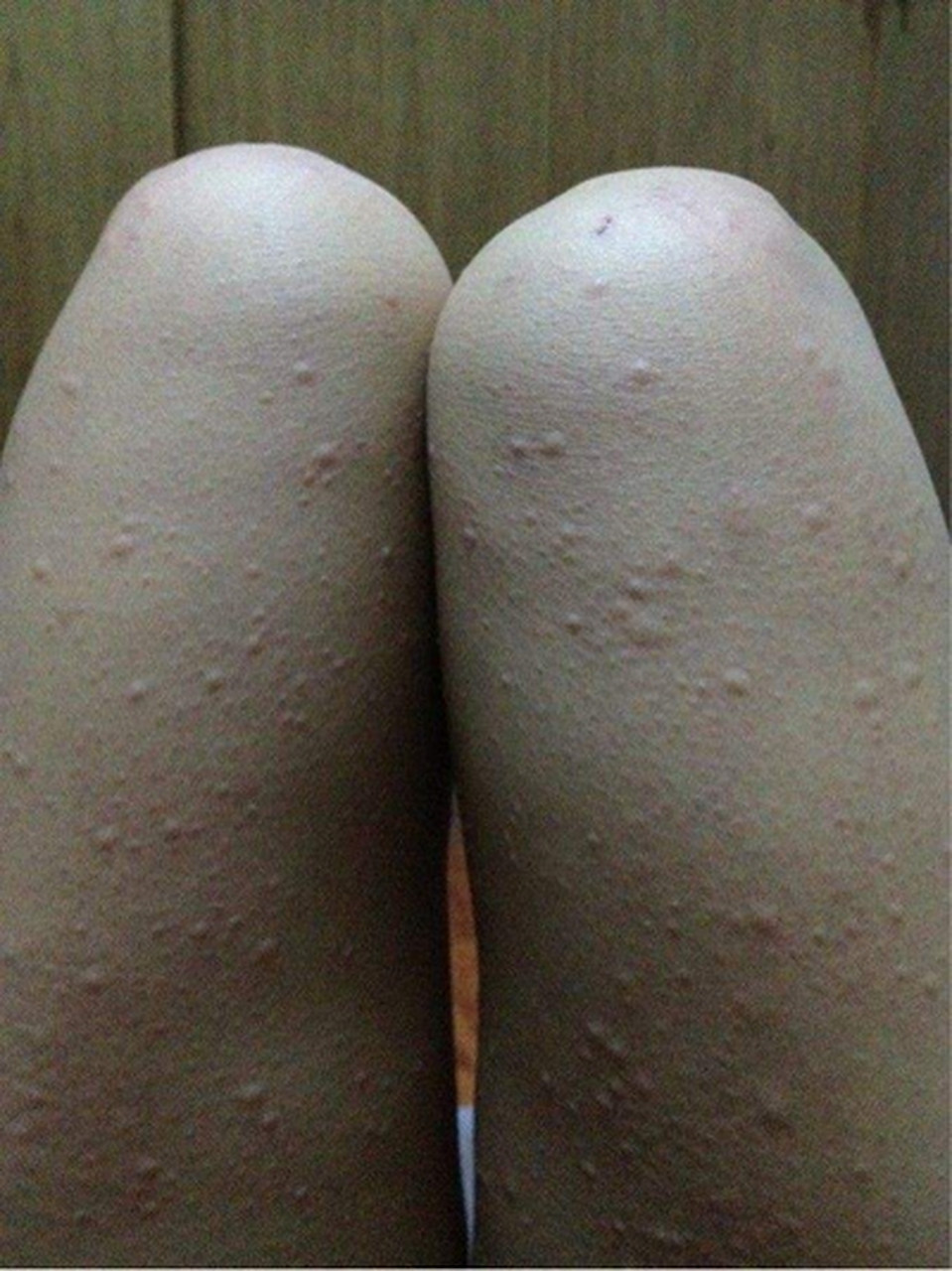 中医对荨麻疹是怎么治疗的?