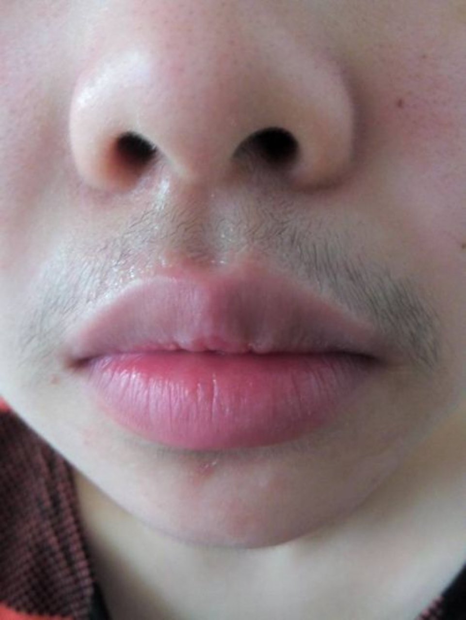 唇毛的解决办法有了!脸部冰点脱毛能搞定!