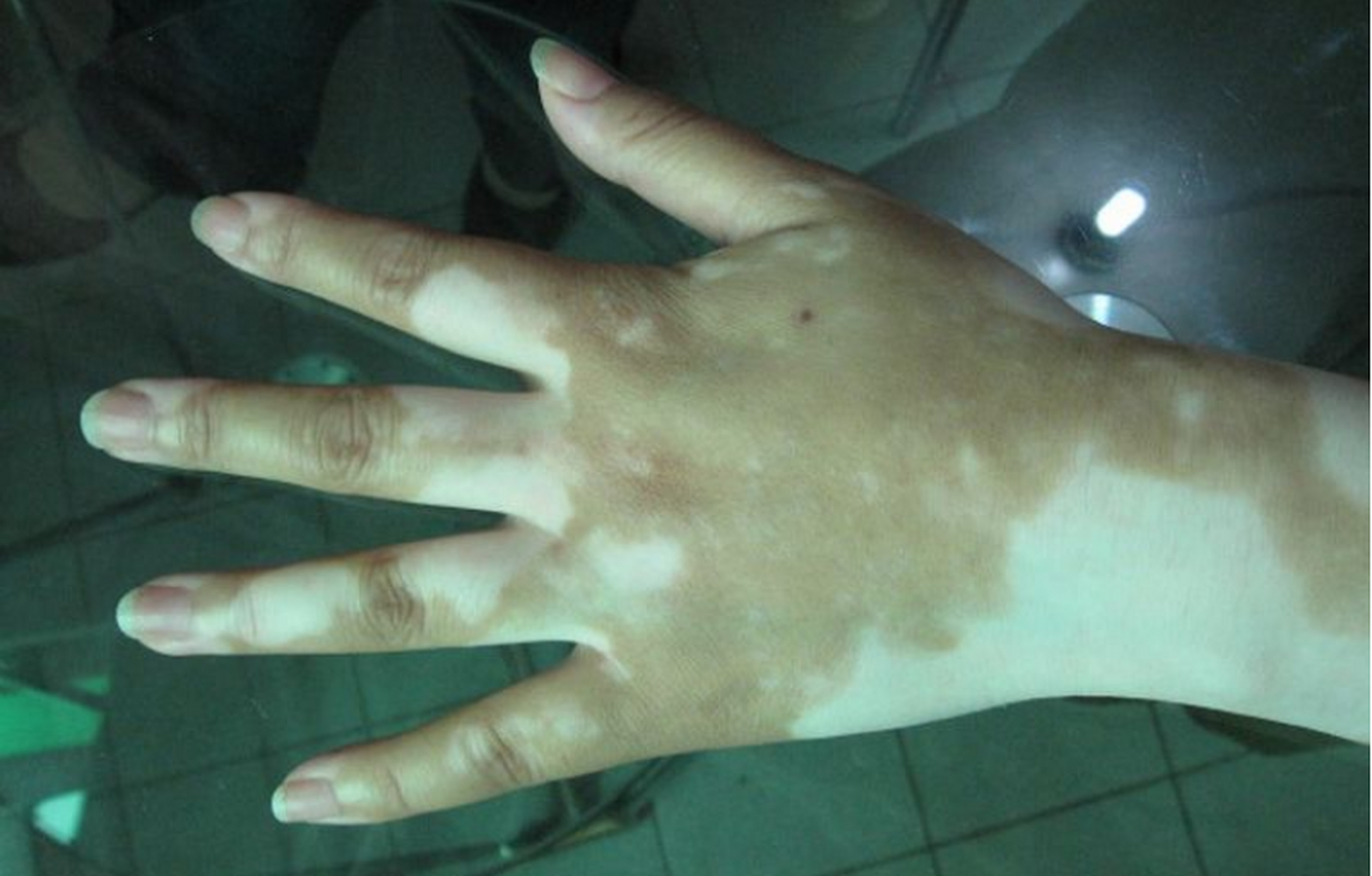 年后上班接诊了一位女患者,手上有大片白斑,起初只有硬币大小,不疼