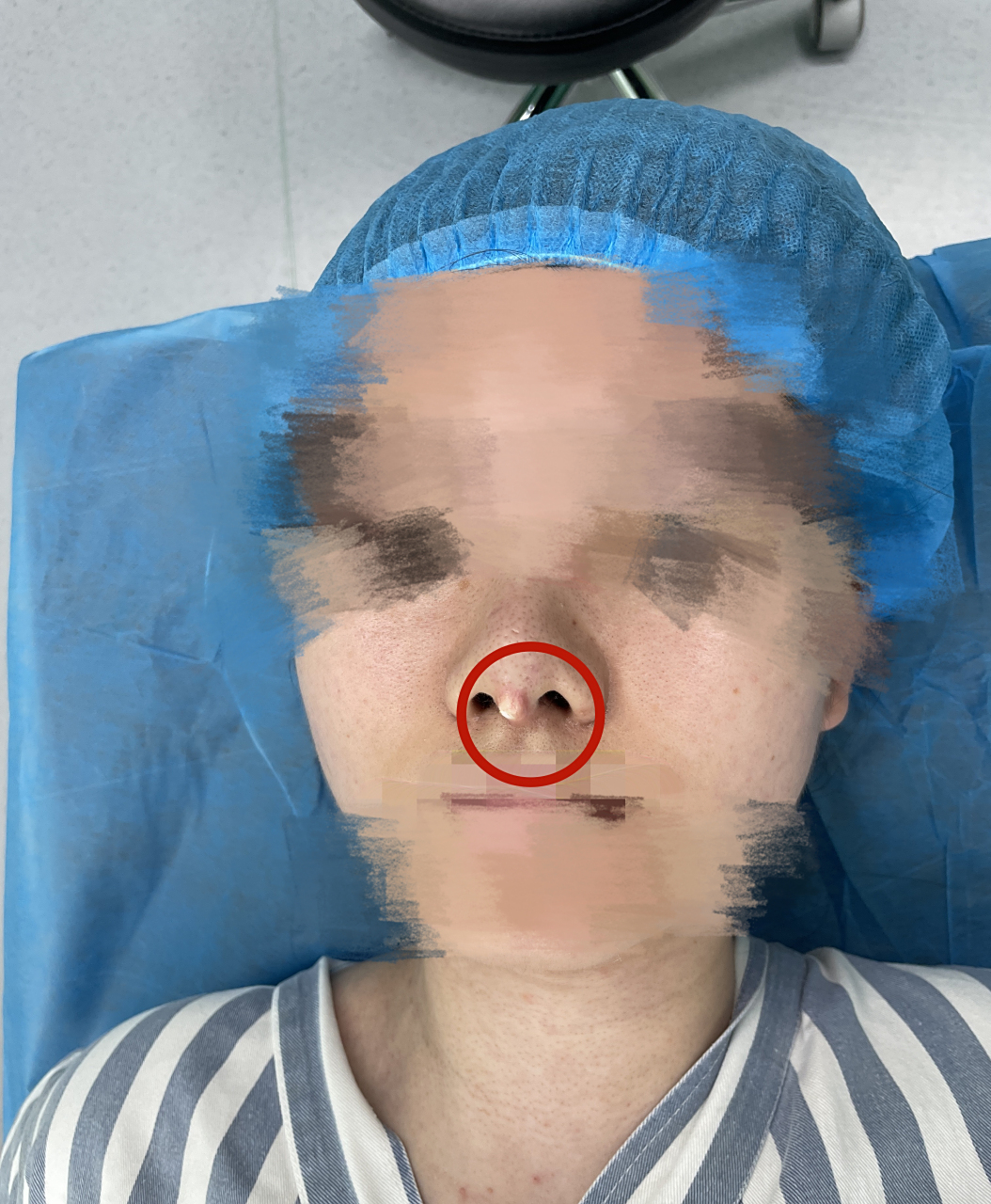 之所以会出现顶破鼻尖的情况,主要有3个原因: 1.