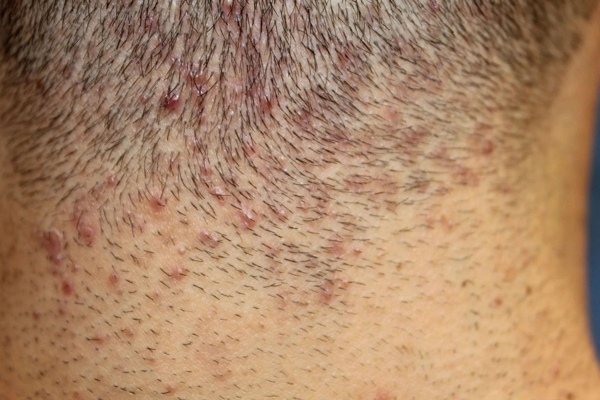 其实这是脂溢性皮炎合并毛囊炎.