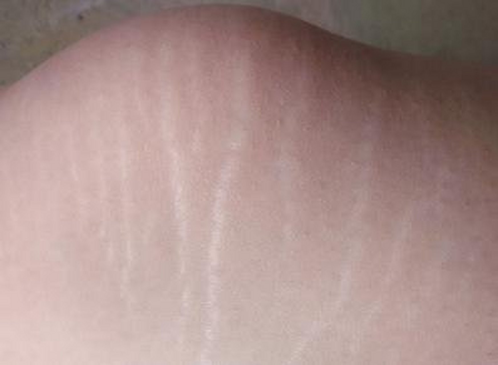 胸部出现膨胀纹,能改善吗?