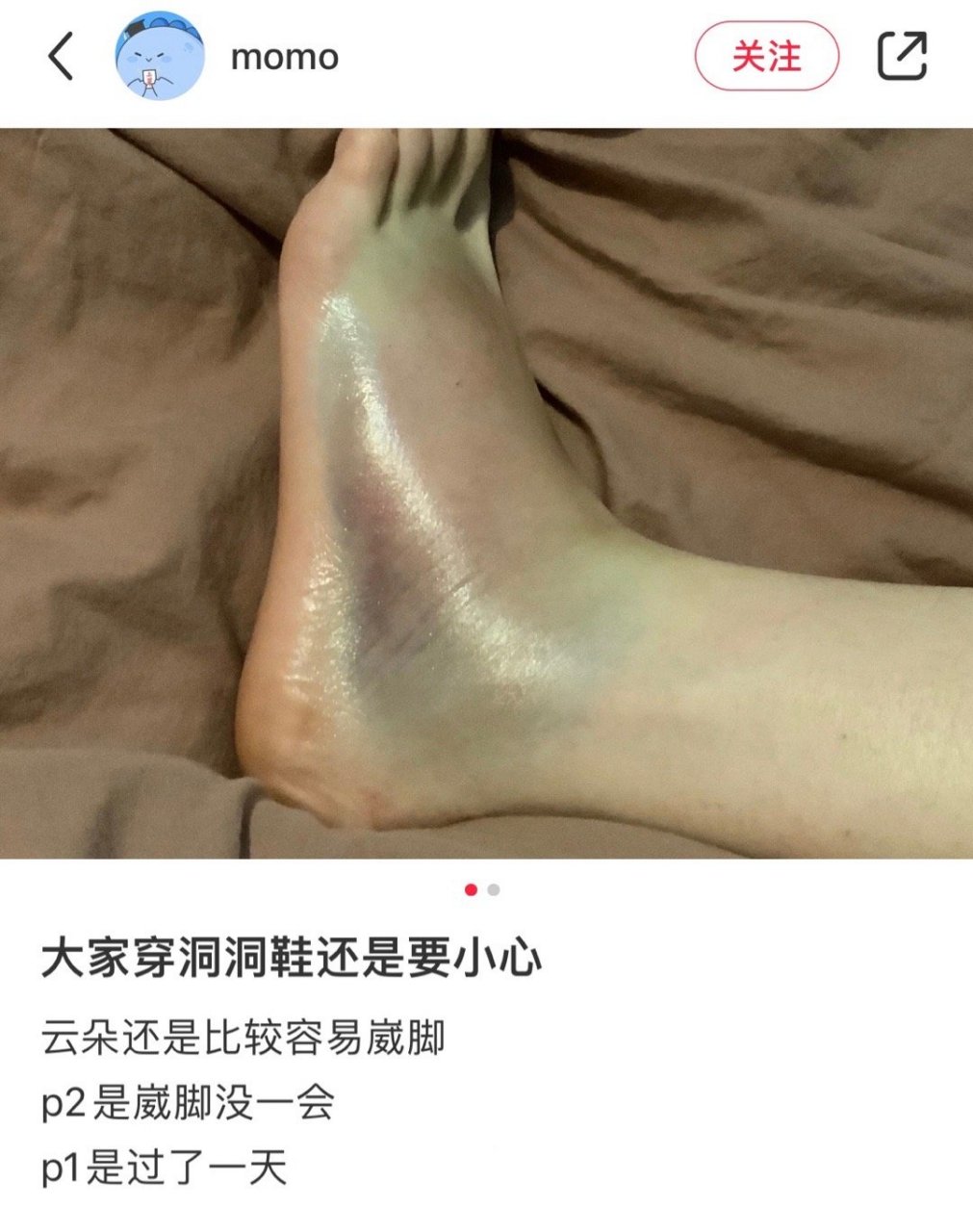 脚崴的照片 真实图片