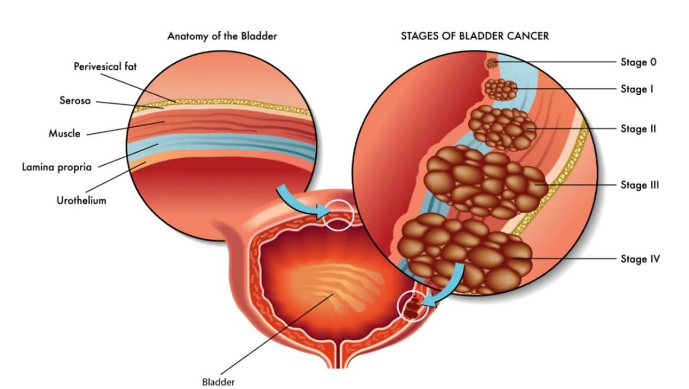 膀胱癌手术后为什么需要进行化疗?