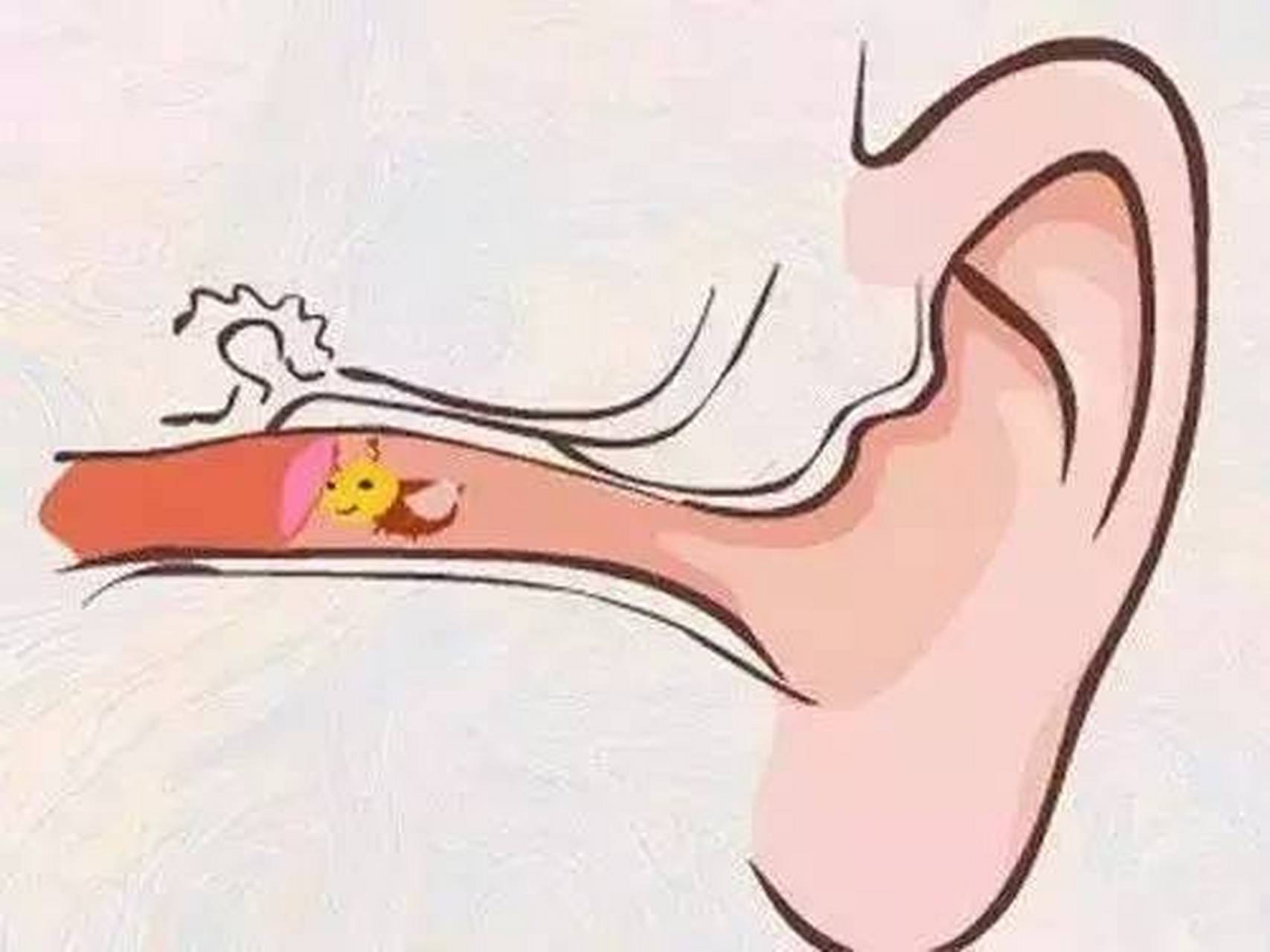 耳朵里面进东西,该怎么处理?分4种情况 1.