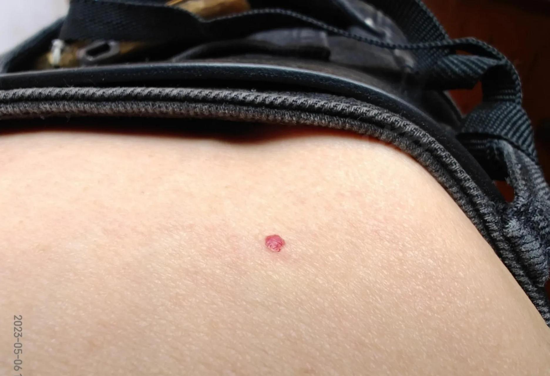 今天又突然发现身上皮肤爆出许多小出血1717点,分布在腹胸部,大腿