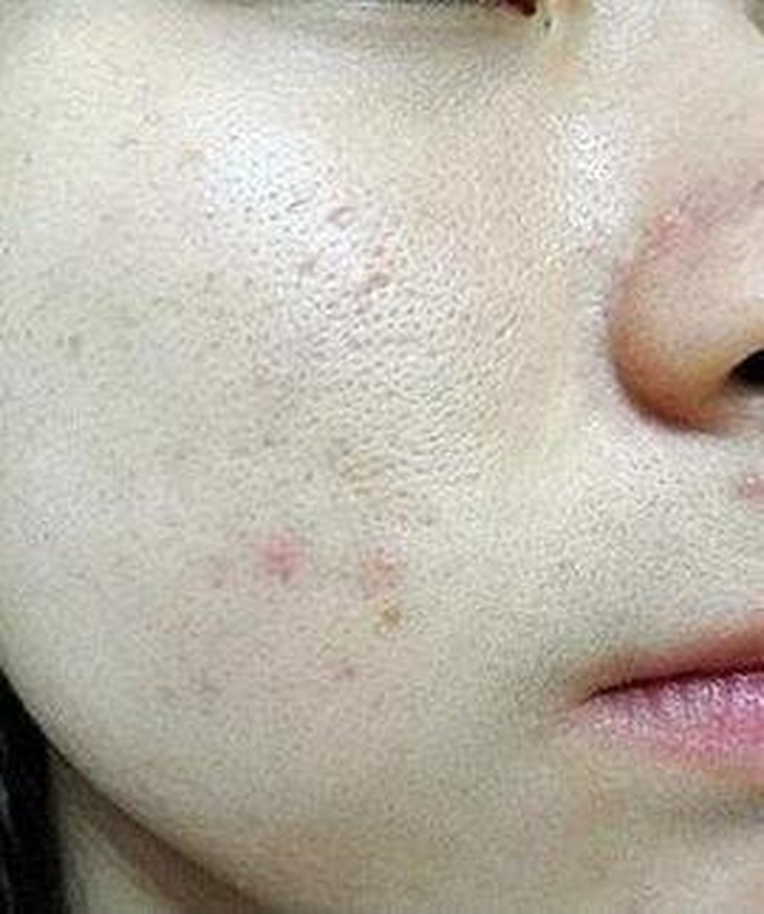 看看自己是否属于以下人群: ①皮糙肉厚,皮肤暗沉,毛孔粗大者; ②油性