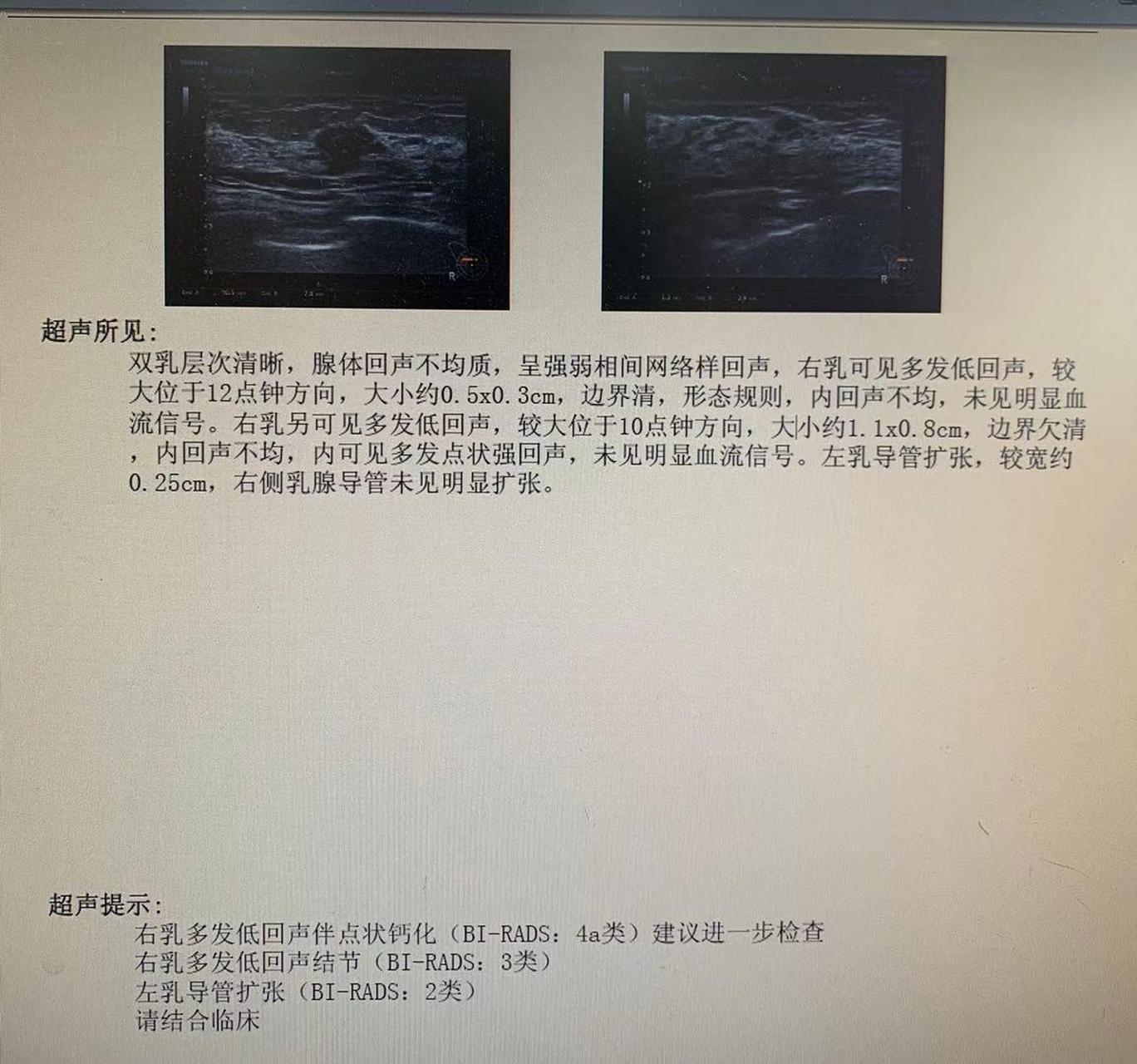 【乳腺结节边界清内部回声不均匀 是什么意思?