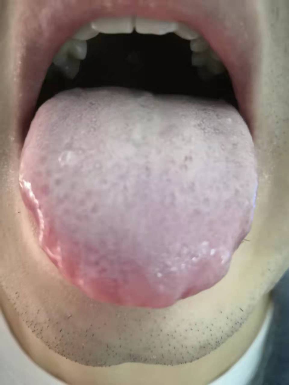 舌苔布满整个舌面,一看就湿气都很重的