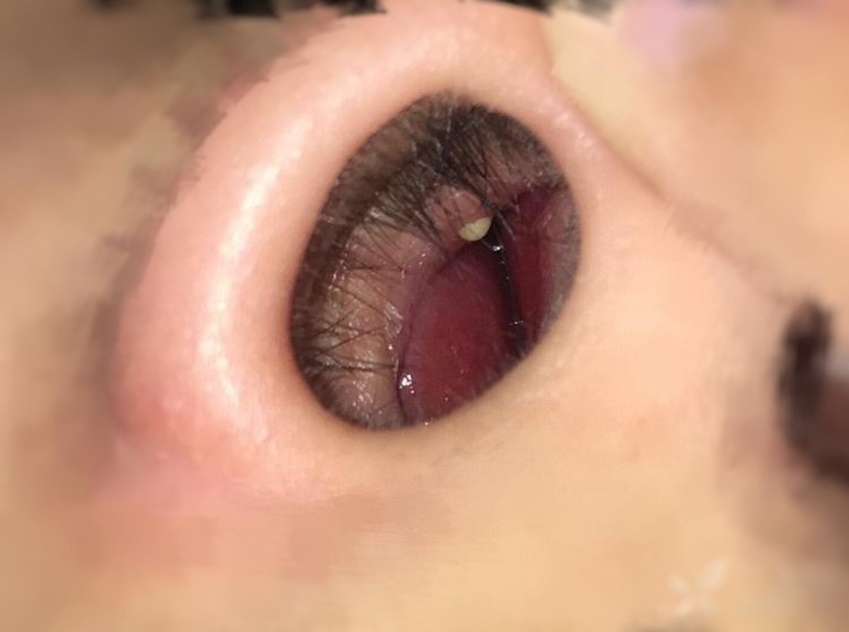 鼻子里面长包,怎么处理.