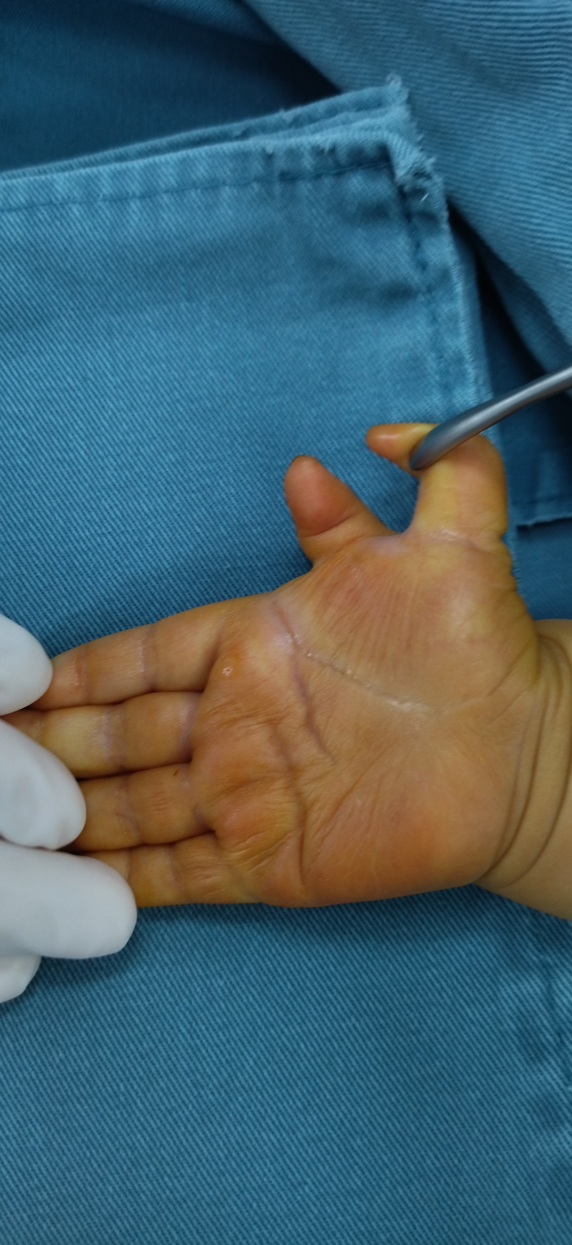 多指手术后,要想和正常完全一样,是有困难的,除非是非常小的漂浮多指