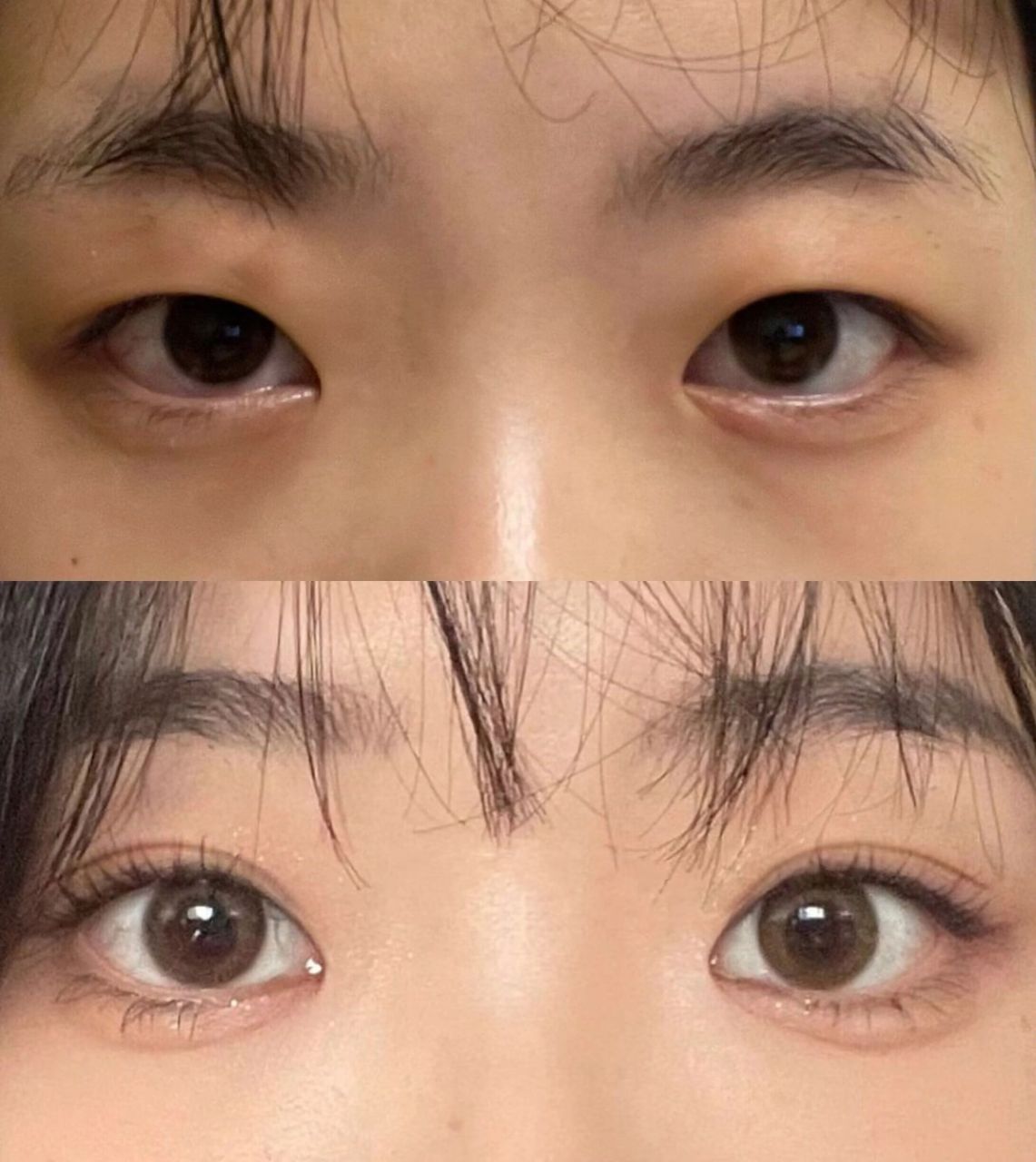 7mm 的平扇双眼皮术后看着很自然,感觉眼皮变双后,整个眼睛都变得有神