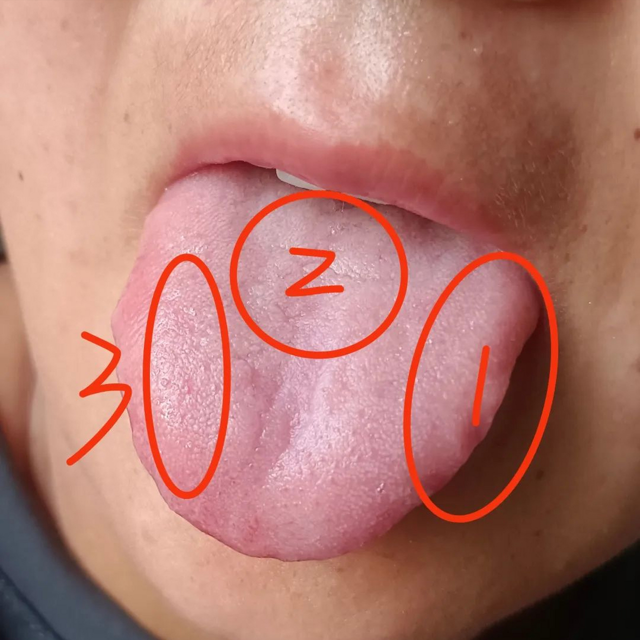 舌像分析:痛经,口腔溃疡  主述:痛经,周期正常,经期三到五天,色暗有