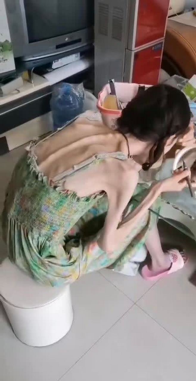 女子减肥成瘾患了厌食症,长期营养不良导致现在这个样子.
