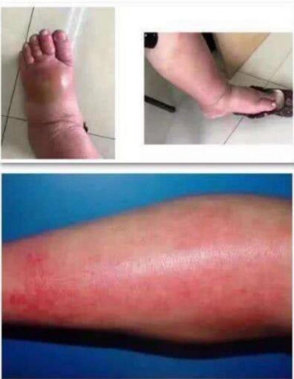 【丹毒】足部真皮浅层的淋巴感染,以红肿热痛为主要特征,严重的还会