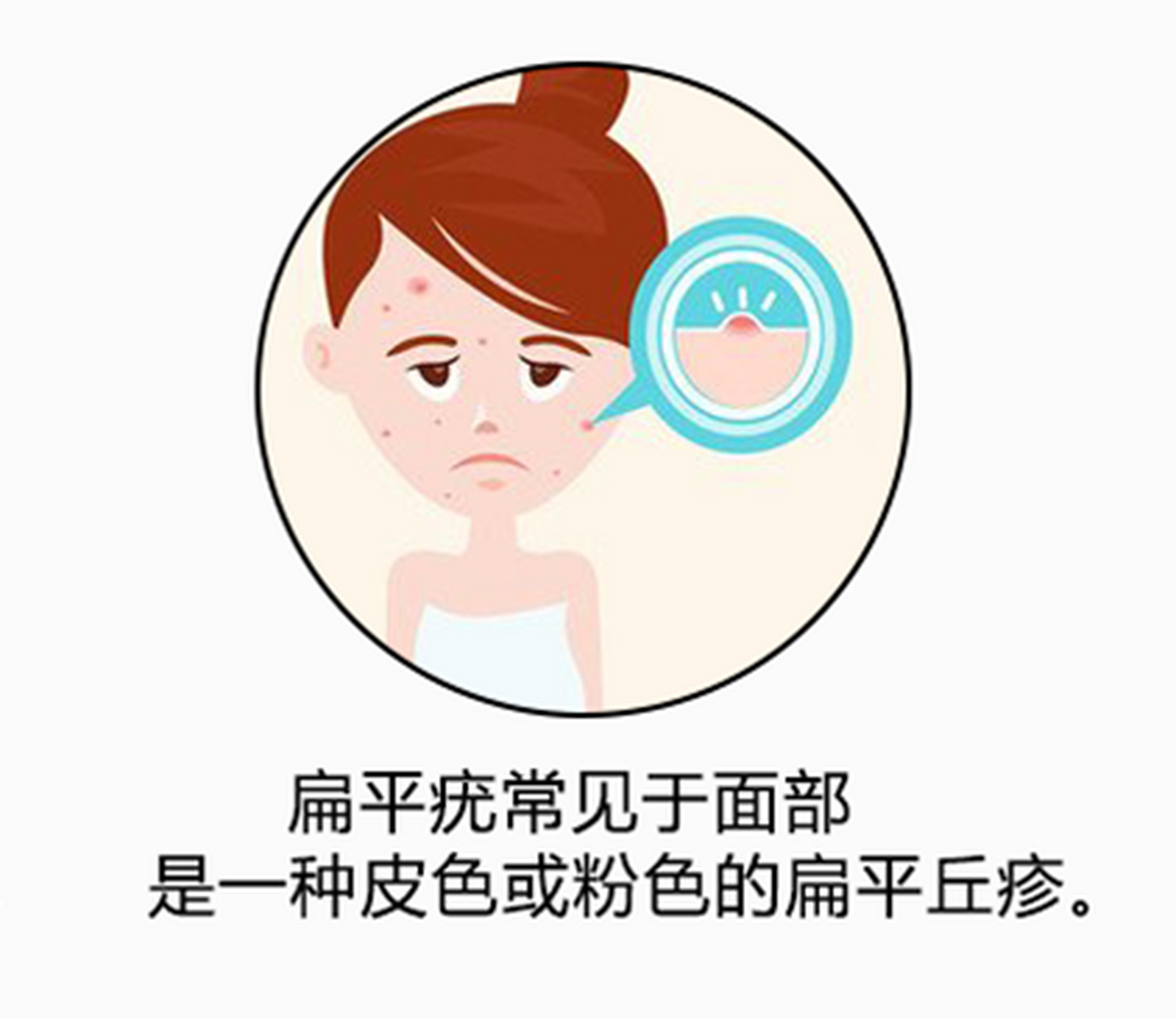 身上5种疣跟hpv感染有关 1.