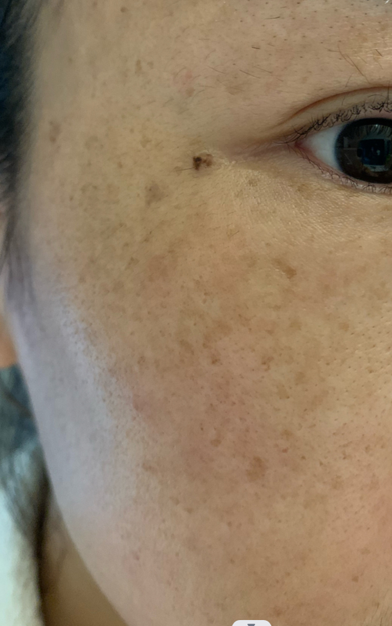 俗称蝴蝶斑,是女性面部常见的皮肤病之一,为面部的黄褐色色素沉着