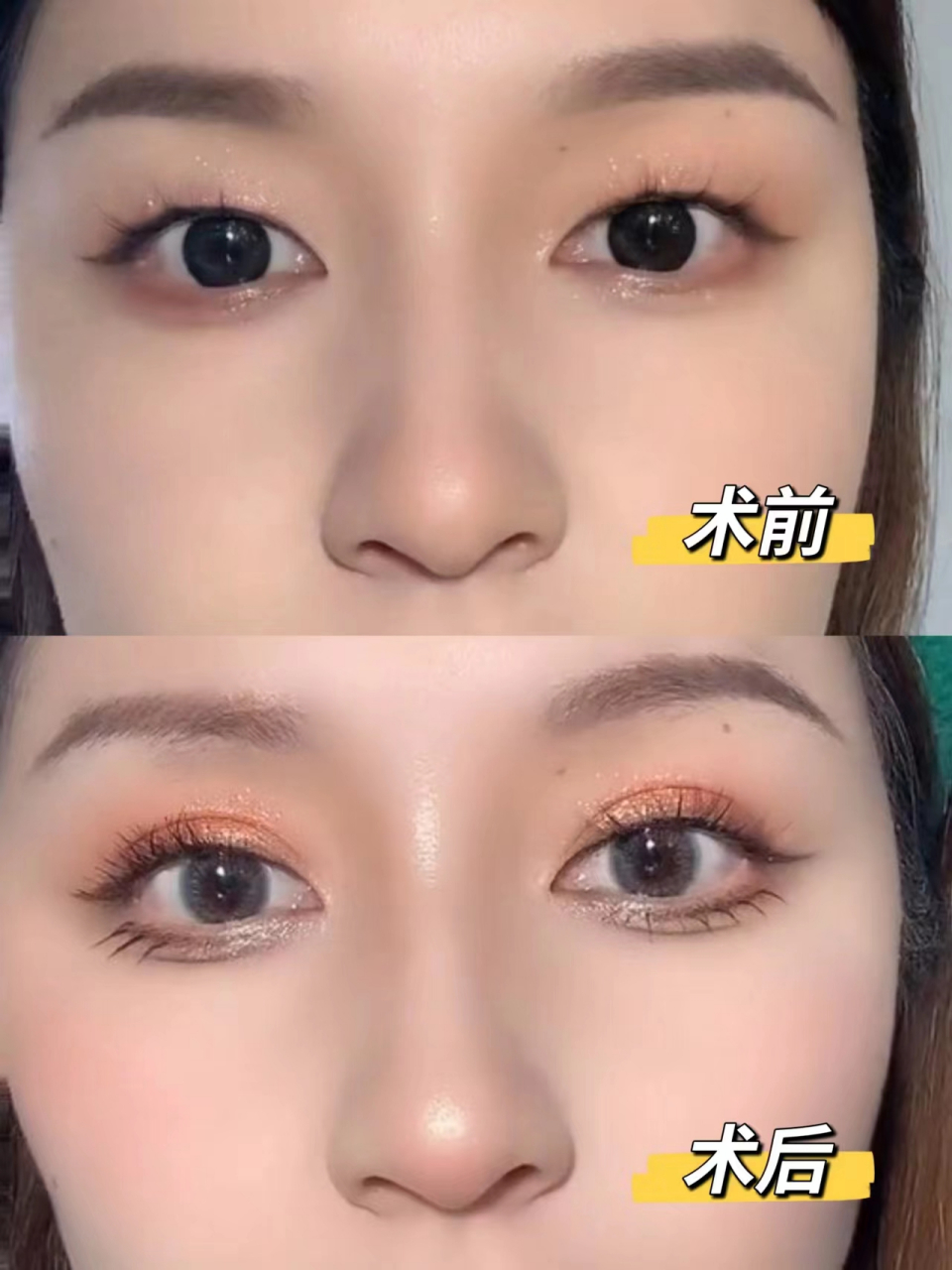 埋线双眼皮能维持几年 因为自己本身是内双,所以意识到有双眼皮会更