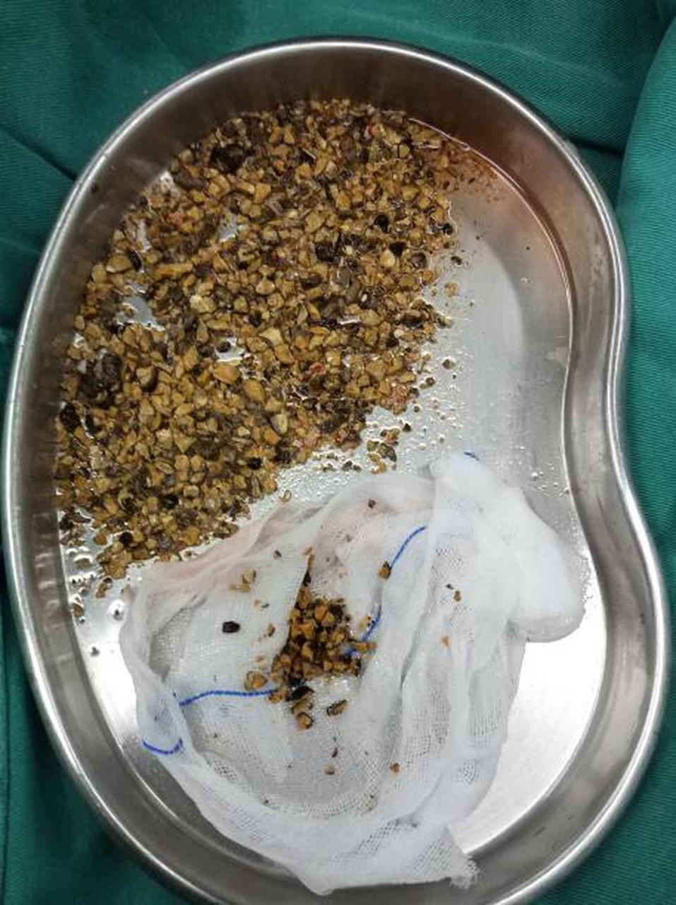 体检发现肾结石已经1cm,纠结要不要手术?自己喝水能不能排出来呢?