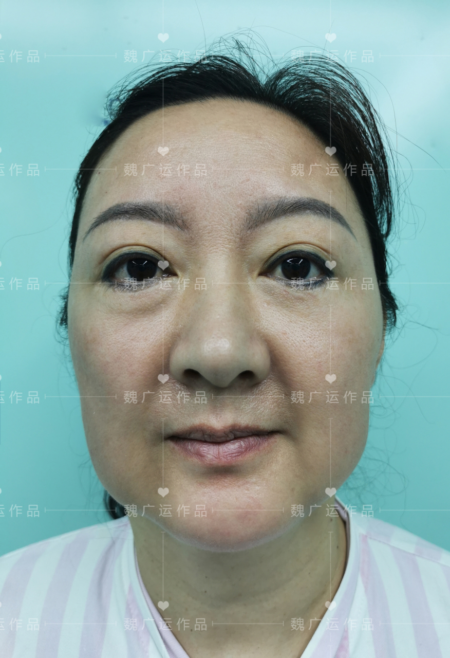 该患者为一名36岁女性,面部松弛严重,轮廓不清晰,法令纹和口角囊袋