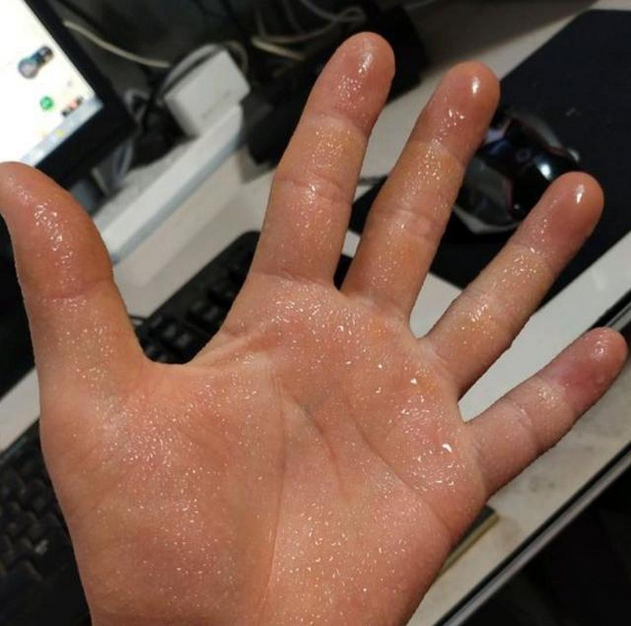 一个15岁男孩,写作业时候,手掌一直出汗,犹如下雨,总是把书本弄的