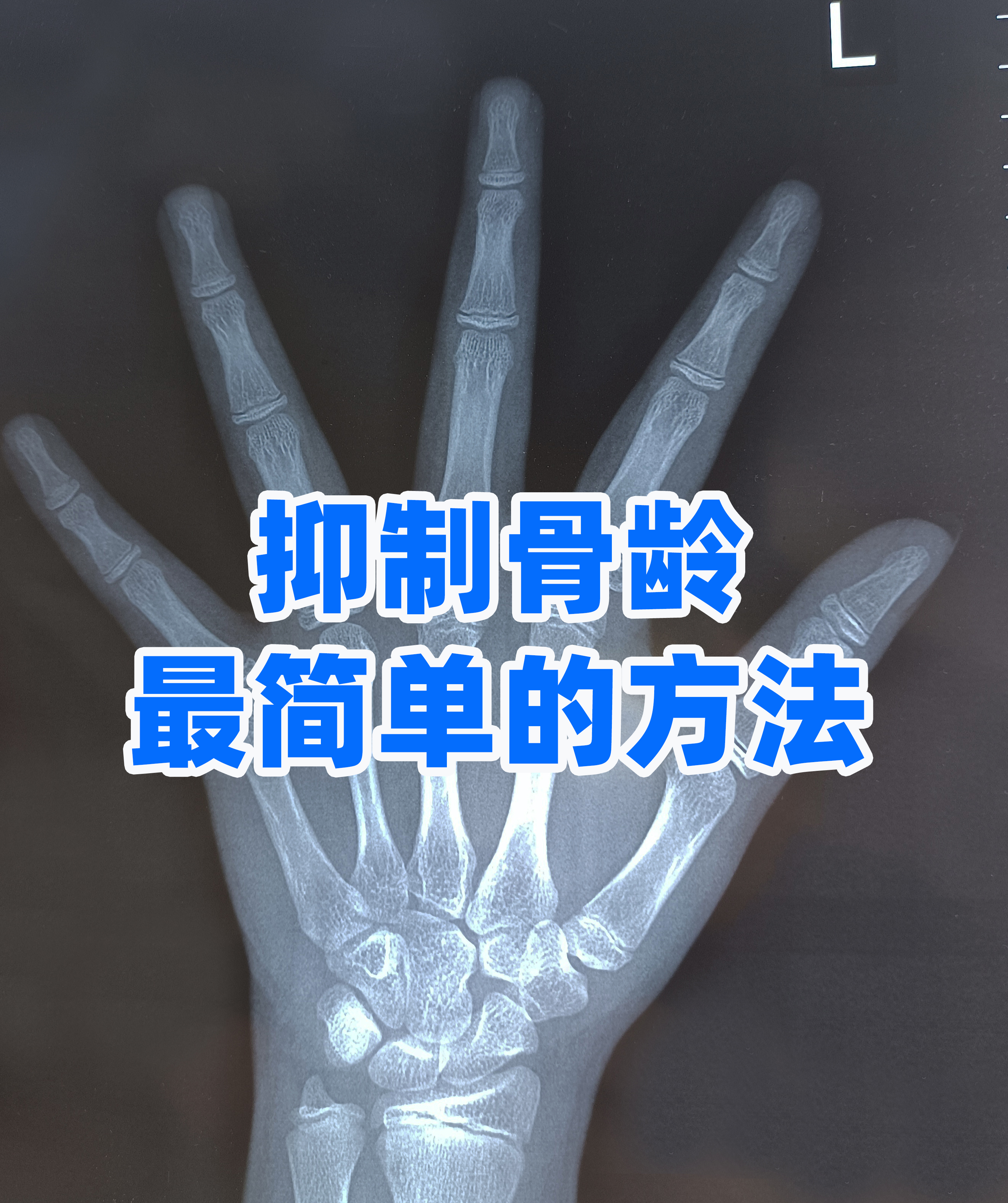 大骨龄的孩子越来越多了有的甚至能偏大2岁3岁生长空间直接被压缩