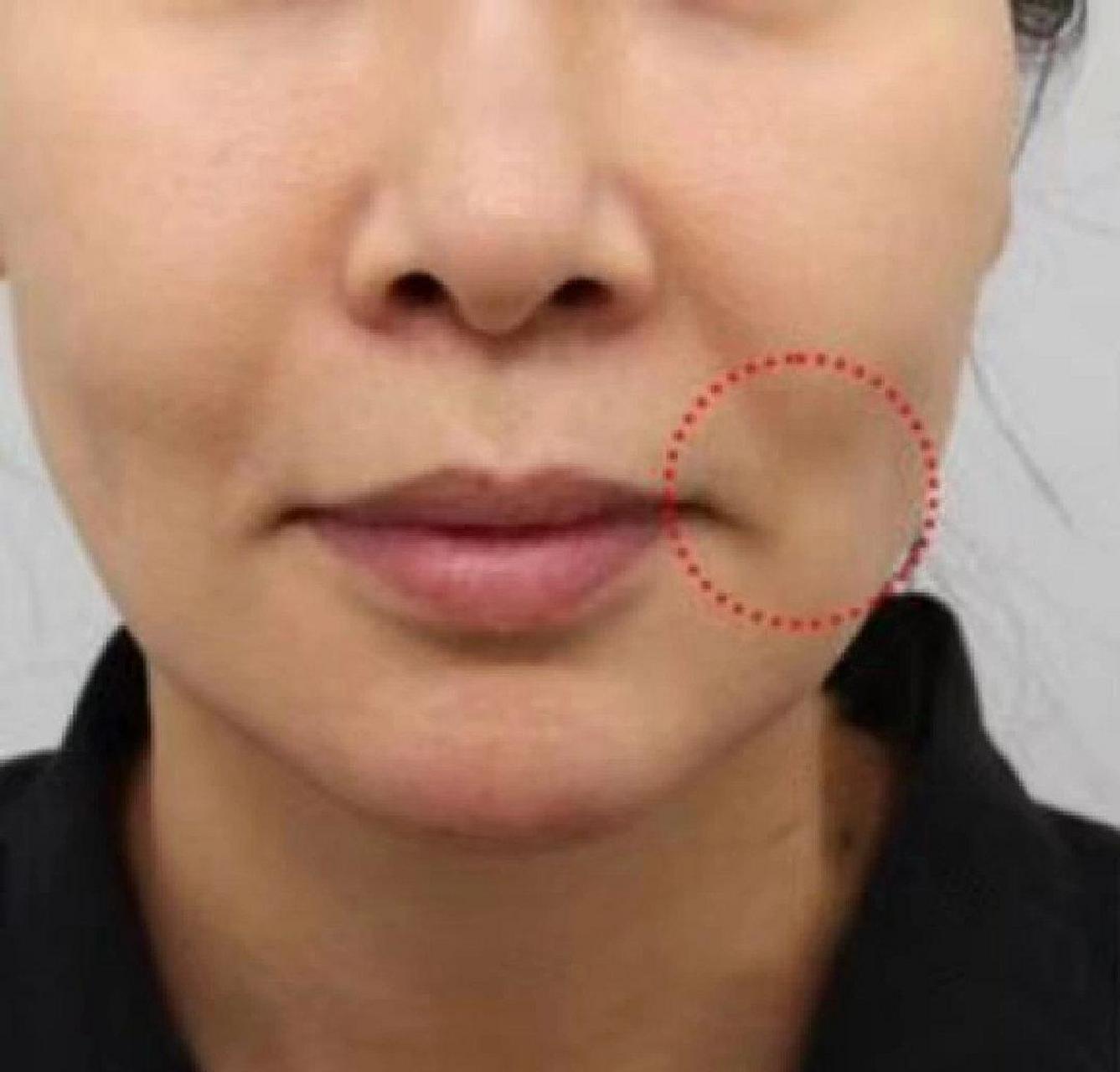 瘦脸 法令纹 口周纹一个月打卡我的脸上的肉捏起来有肉,能提起来的