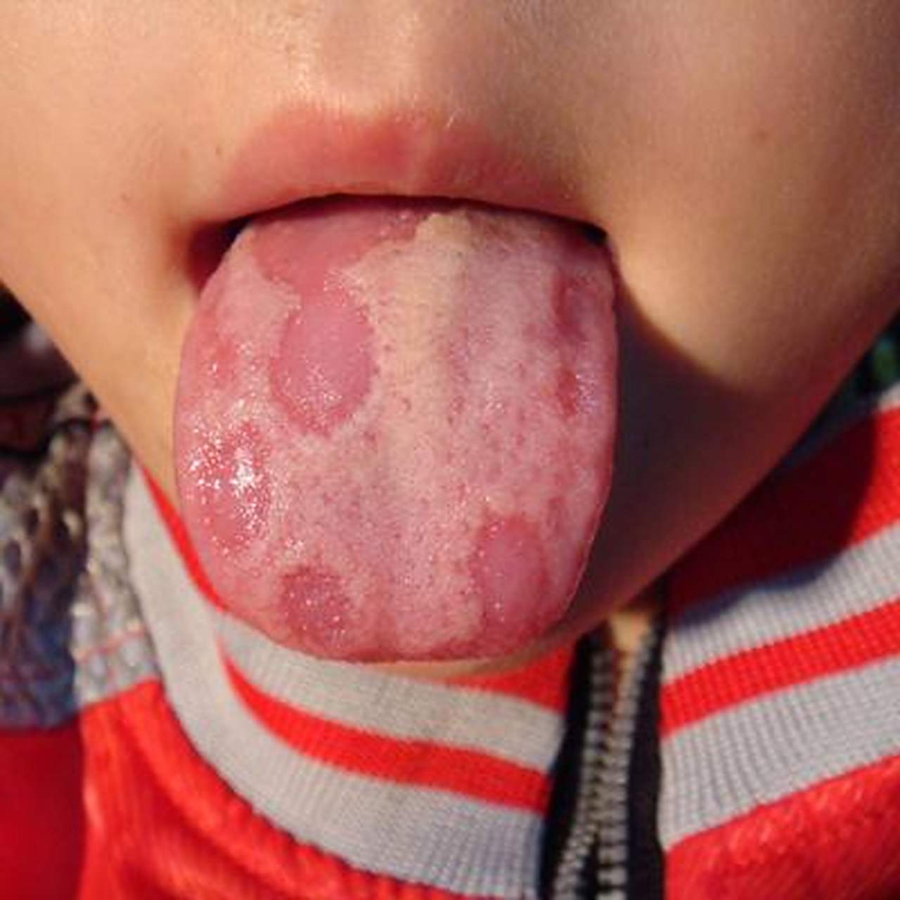 去年我接诊了一位频繁出现地图舌的孩子.