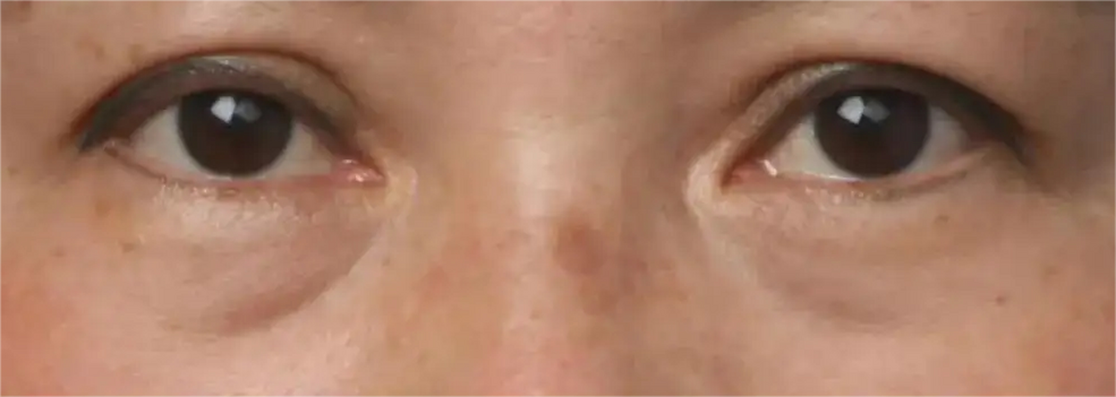 40 眼袋泪沟太显老,医生告诉你:如何解决泪沟眼袋双重问题!
