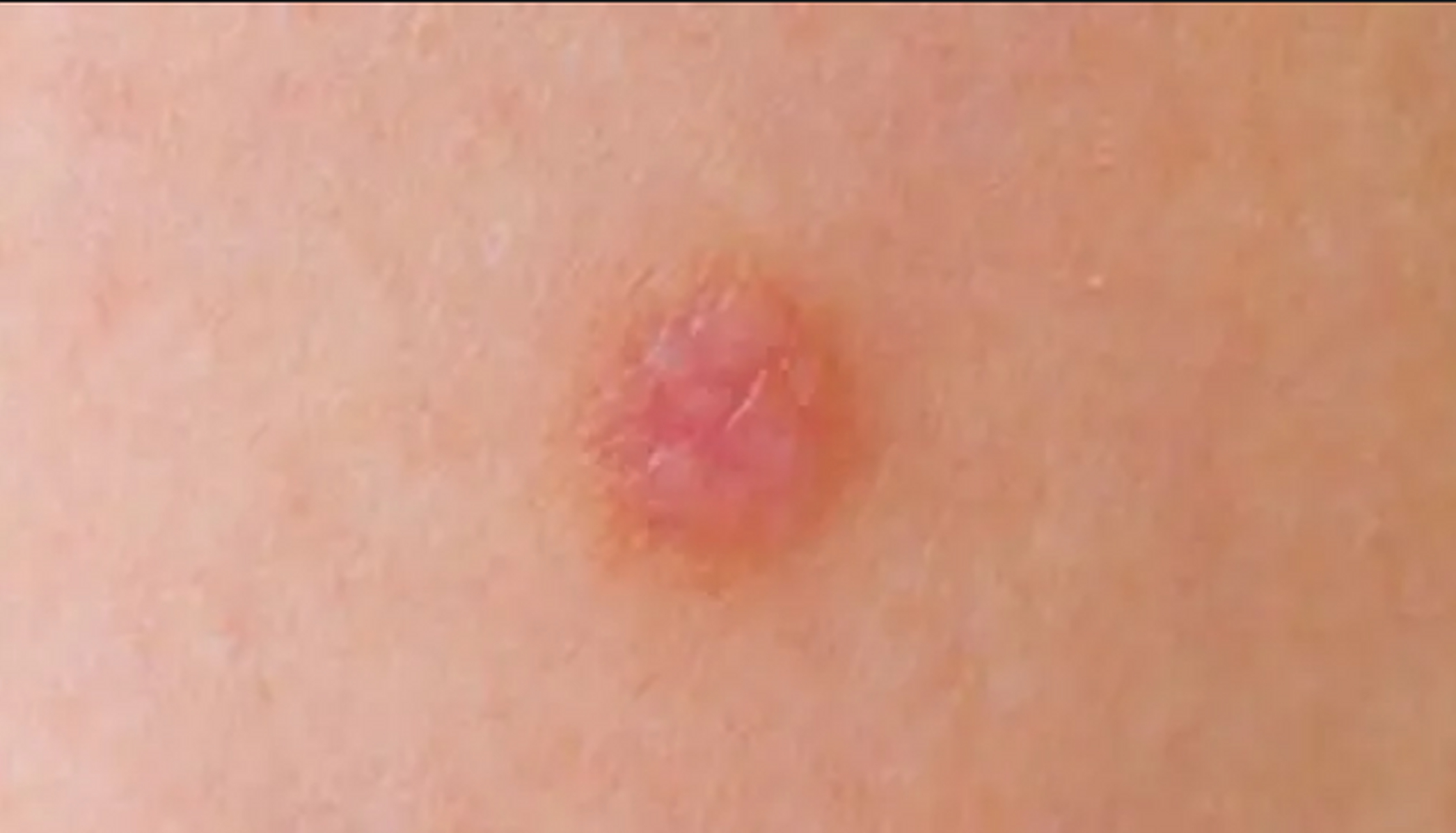 感染 hpv 后,3 种症状要小心,最好一个都没#hpv转阴方法# #hpv# #hpv