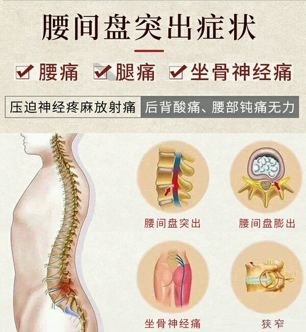 弥可保 腰椎间盘突出图片