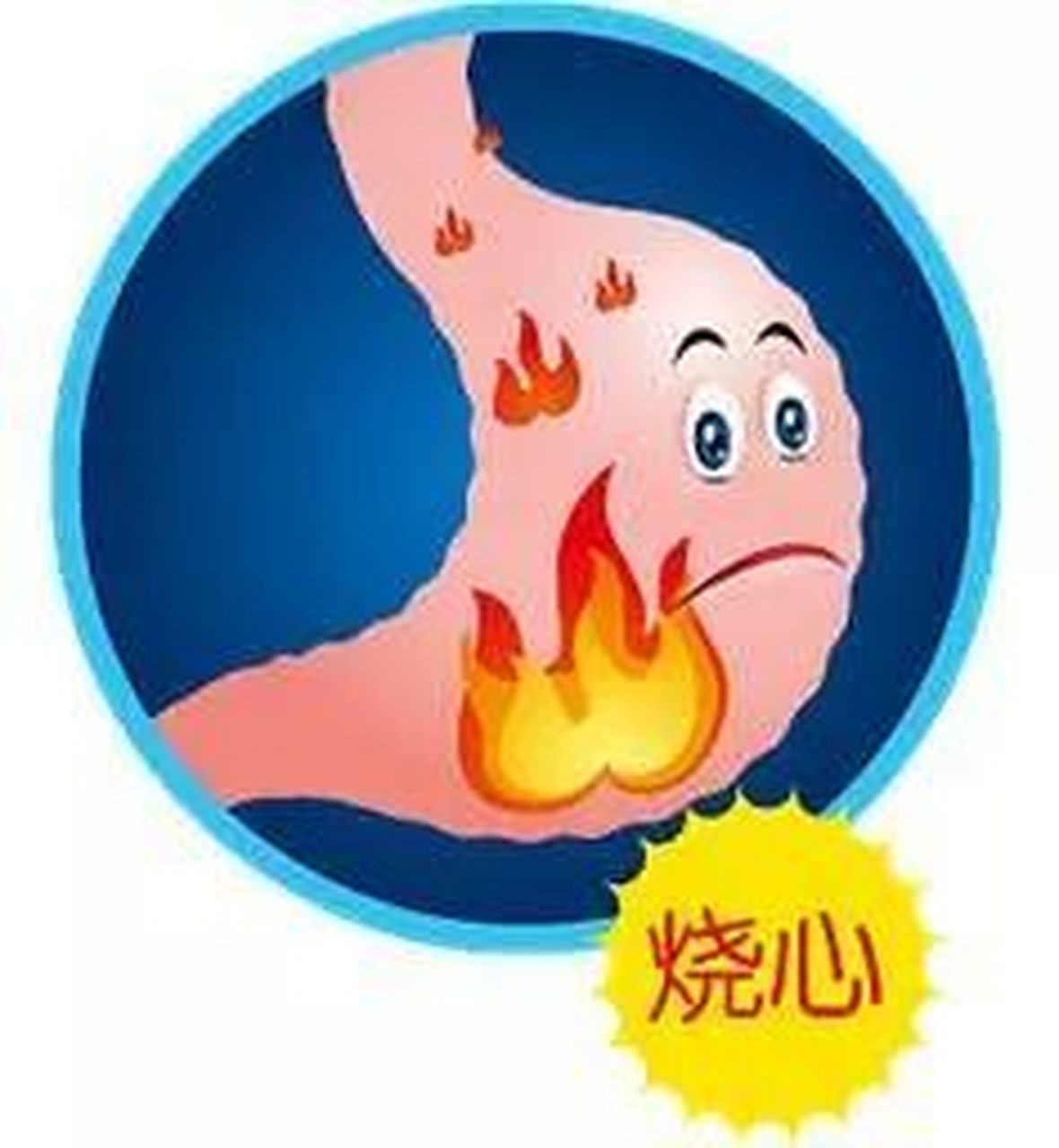 烧心##反酸# #胃酸反流怎么办#  胃反酸,烧心一般多考虑存在胃食管反